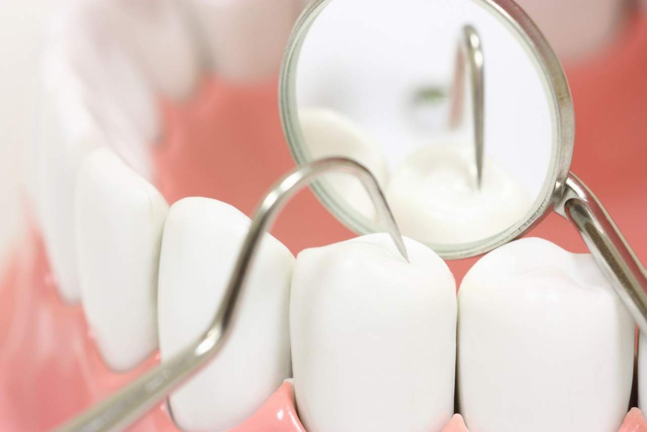 Precios de los implantes dentales en Sevilla