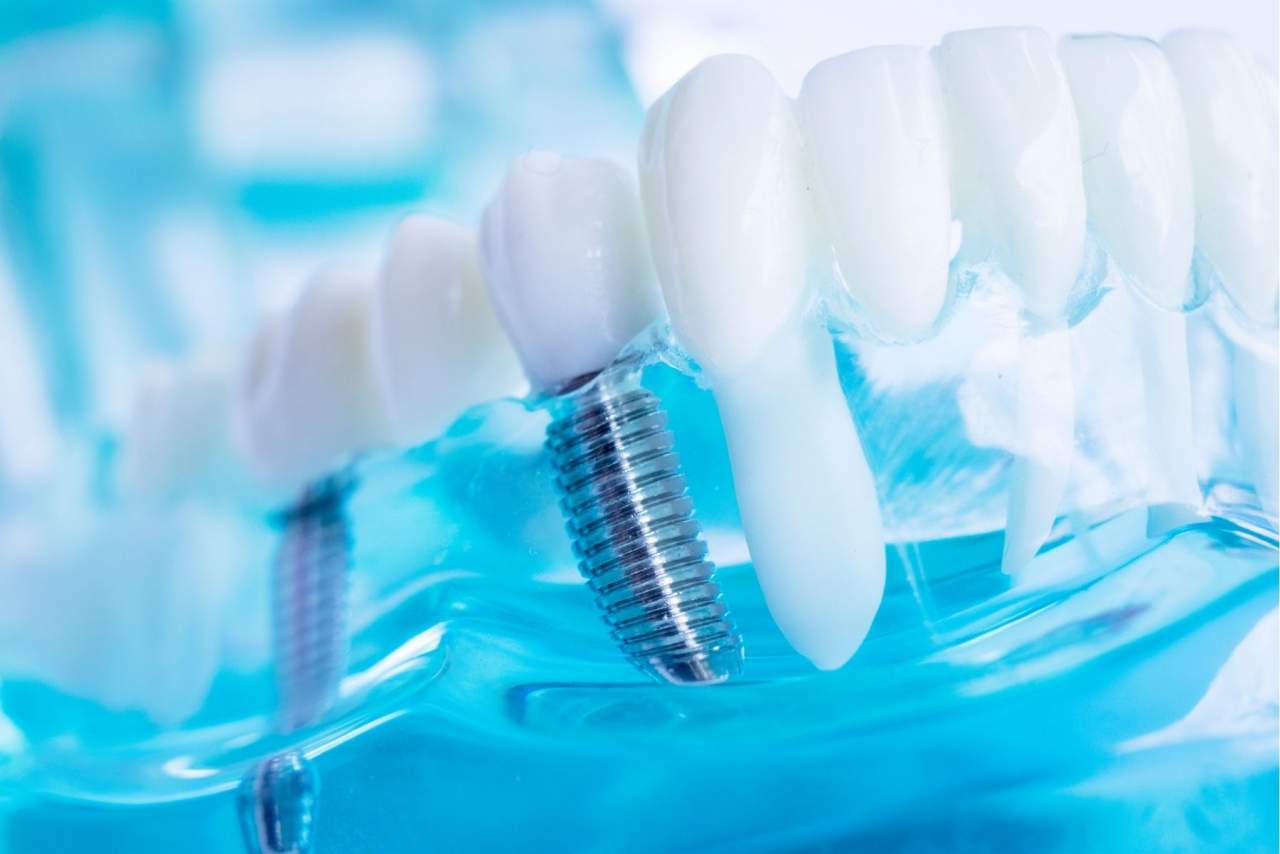 Magníficos resultados con los implantes Dentix en Sevilla