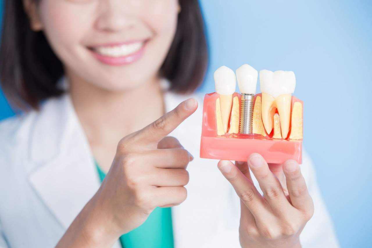 Sonríe una vez más, y cómete el mundo: Implante dental Sevilla