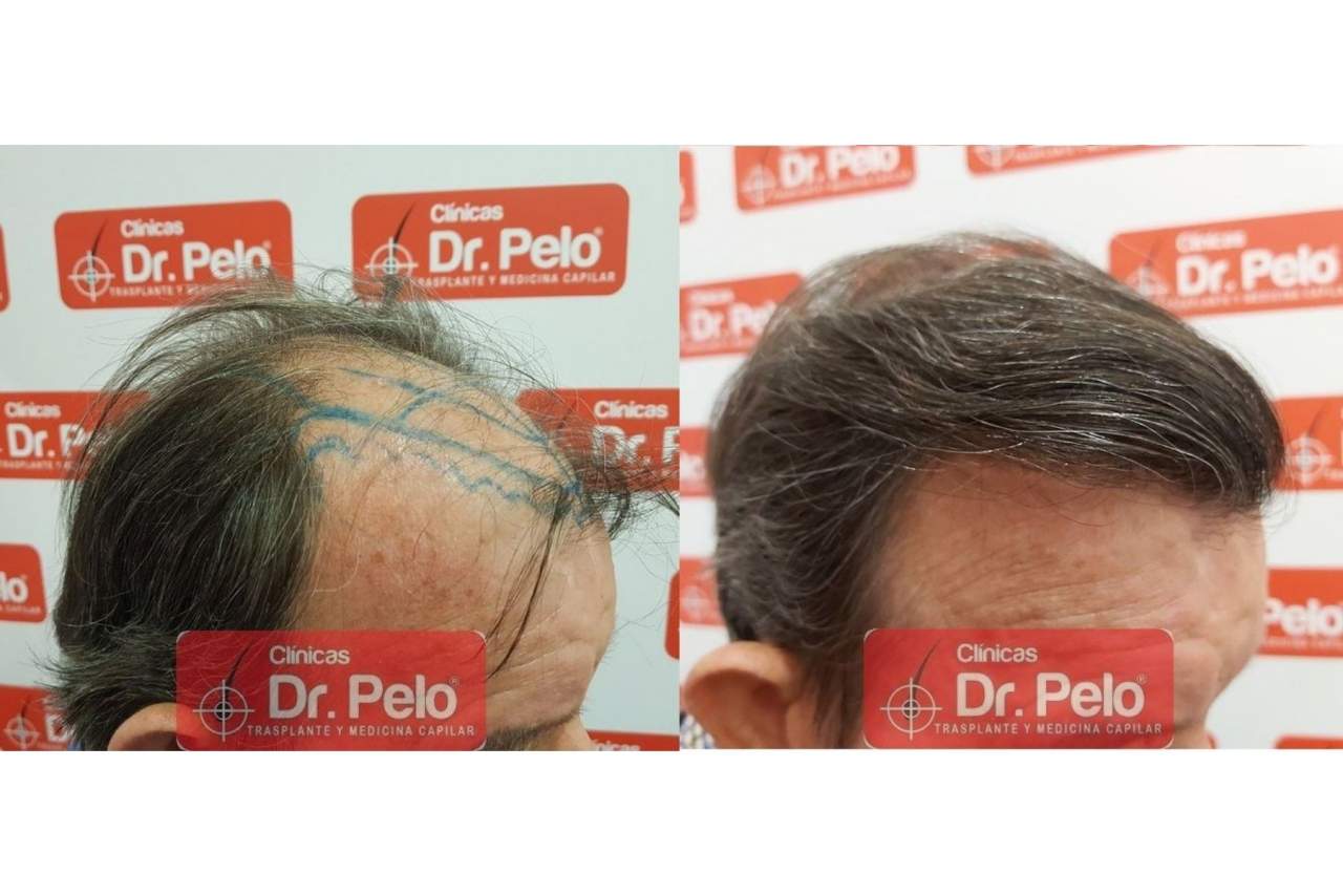 Trasplante capilar en Madrid: Clínicas Dr. Pelo