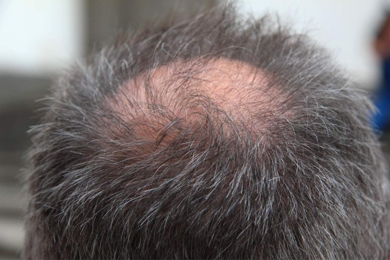 ¿Cómo prevenir alopecia androgenética? Natura Estilo