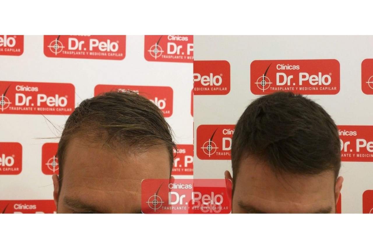 Señales de alopecia Dr. Pelo