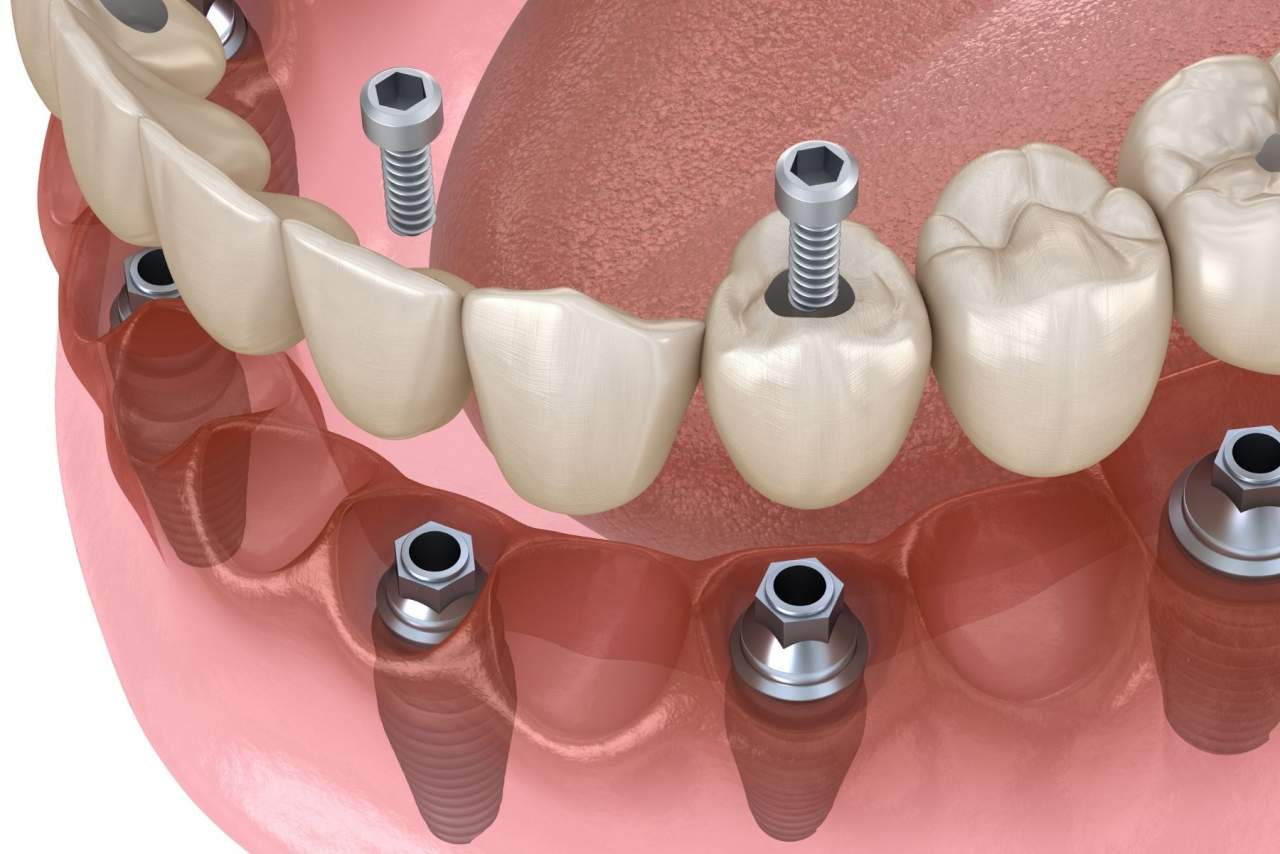 Helident Training Center: ¿Los implantes duran para siempre?¿Qué cuidados necesitan?