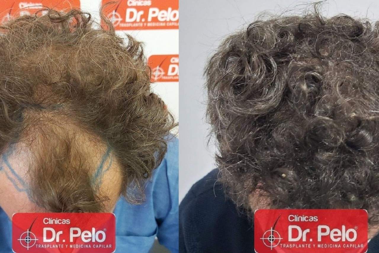 Injerto capilar en Sevilla: la técnica de la Clínica Dr. Pelo