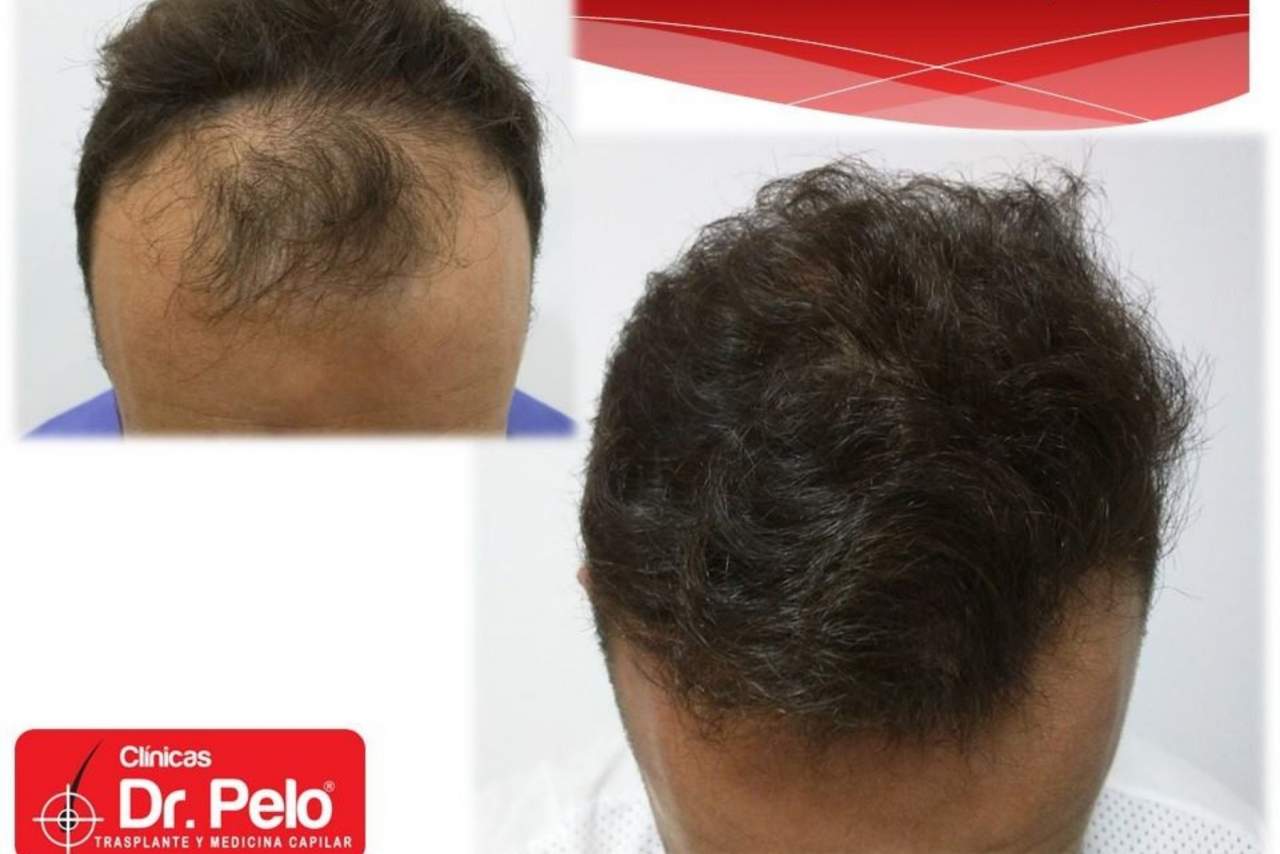 ¿El trasplante capilar es la nueva tendencia en medicina estética?: Dr. Pelo