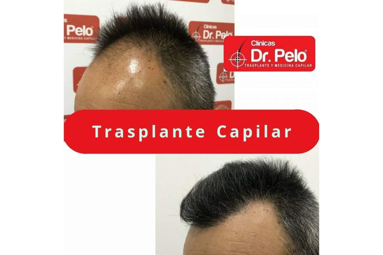 Opiniones sobre el injerto capilar de las Clínicas Dr. Pelo en Sevilla