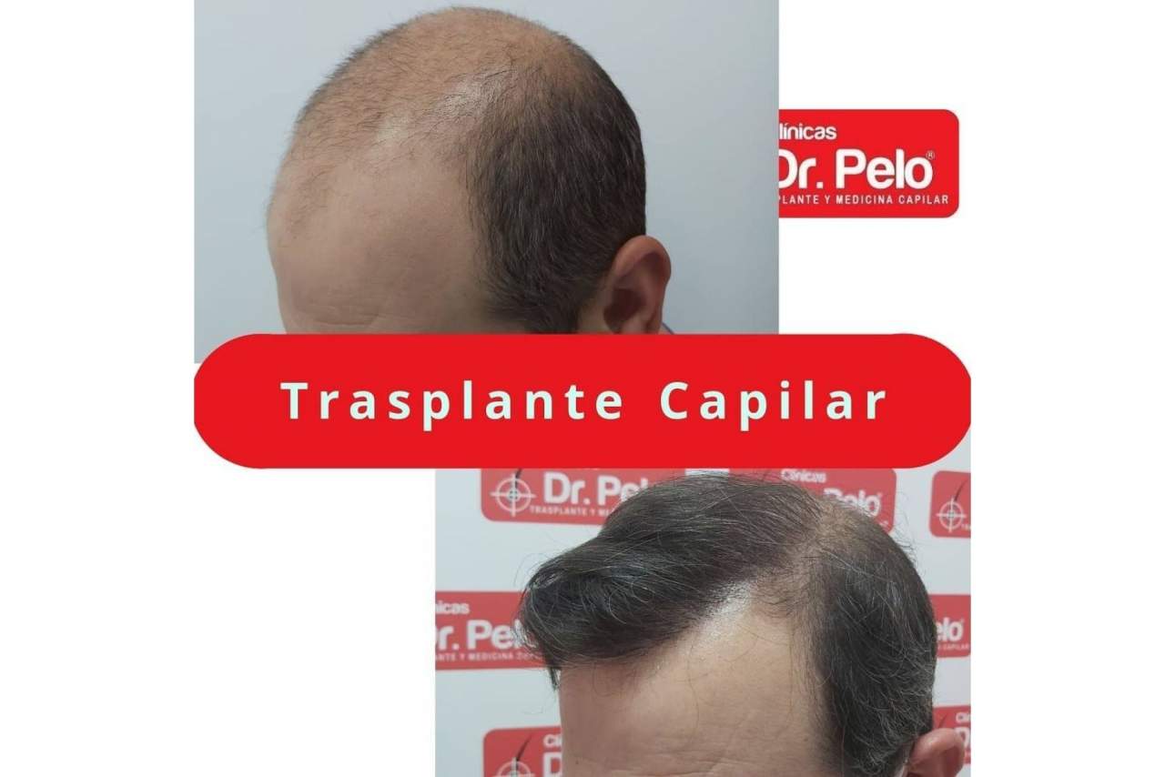 La mejoría en los precios y las técnicas aplicadas provoca el aumento de popularidad del transplante capilar en los últimos años en España
