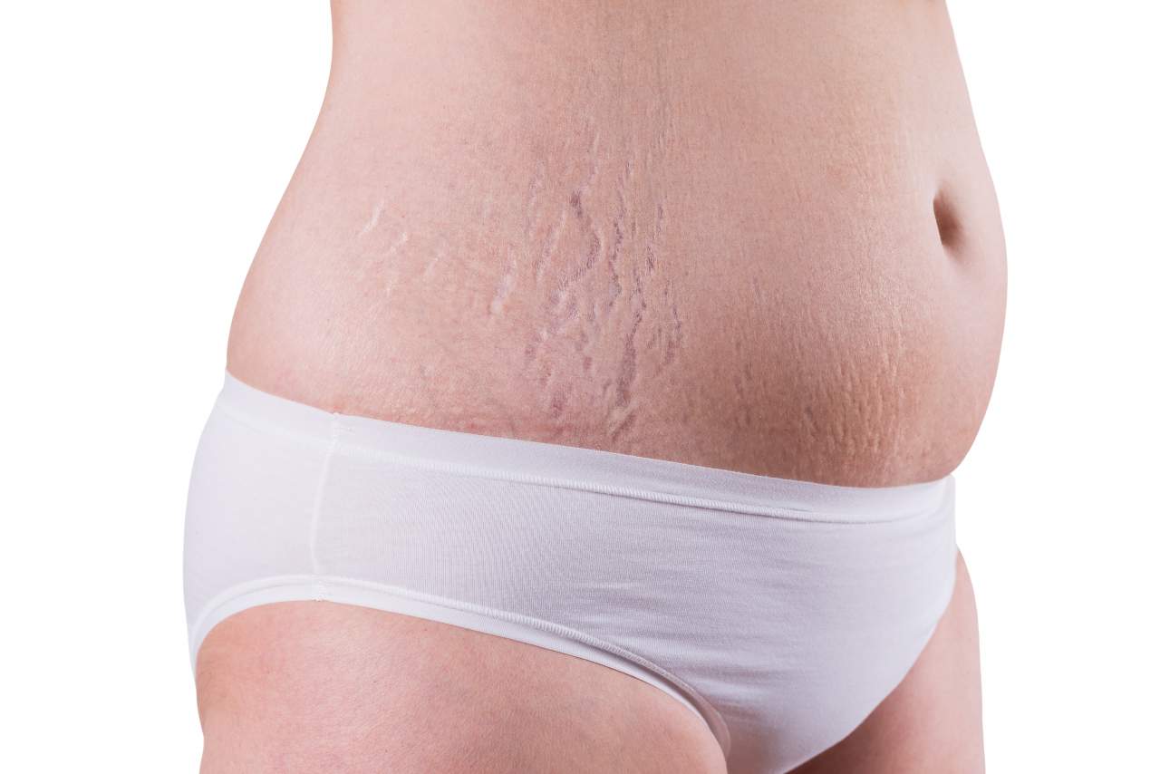 ¿Cómo quitar las estrías en la clínica Estética Alicante?