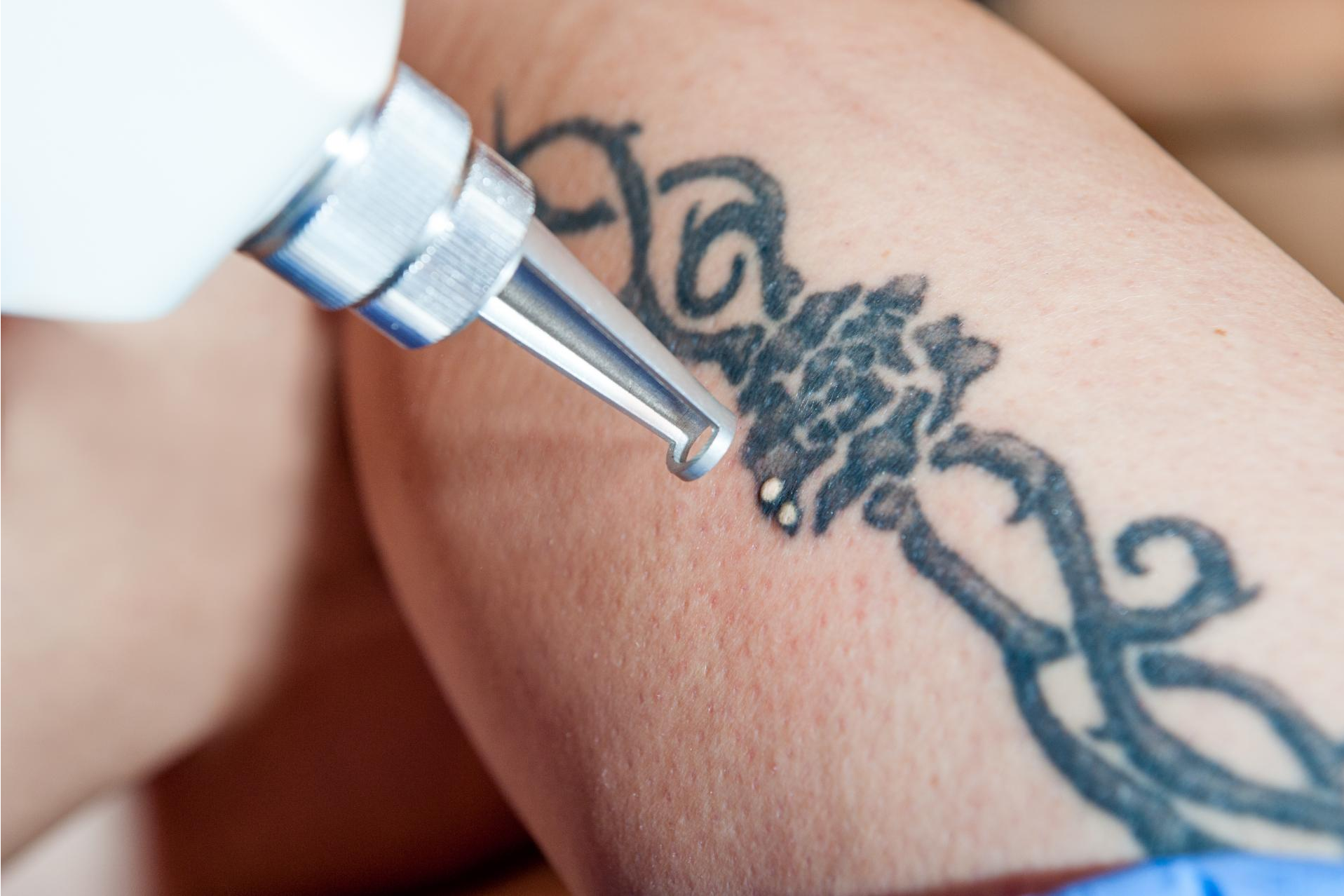 El Yag Láser para eliminar tatuajes se ofrece en el centro Bodyslim