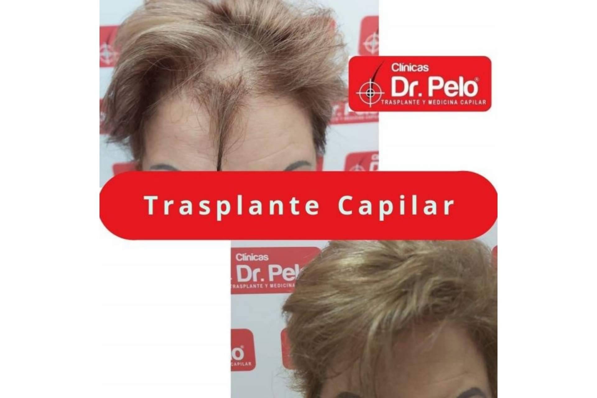 Frenar las entradas en el pelo gracias a los tratamientos y el equipo de profesionales de las Clínicas Dr. Pelo