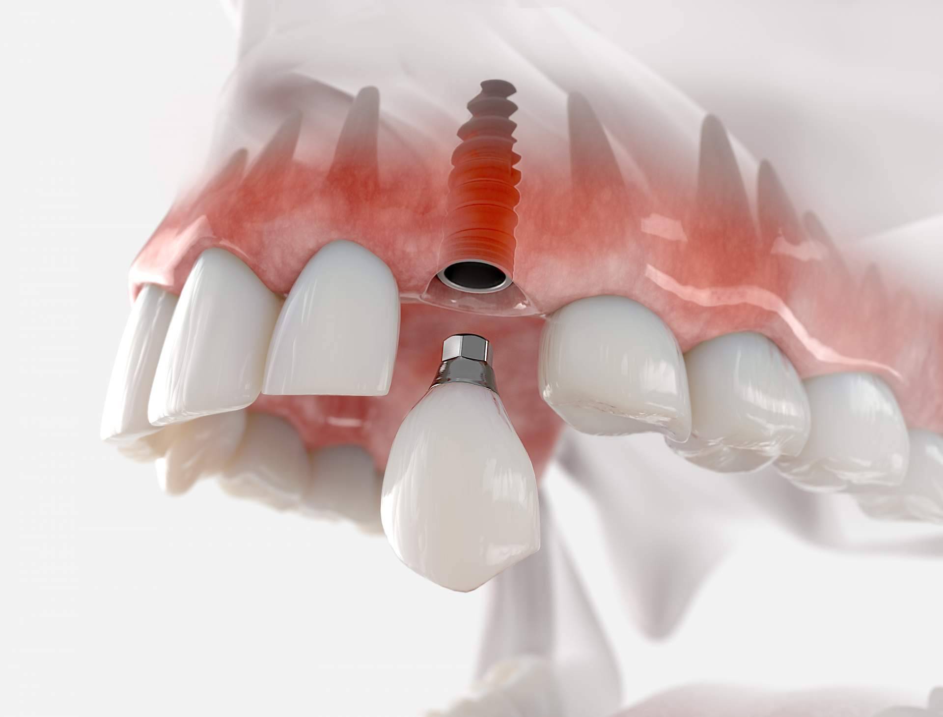 La Clínica Artydents en Madrid, reconocida por la calidad de su implante dental de titanio V