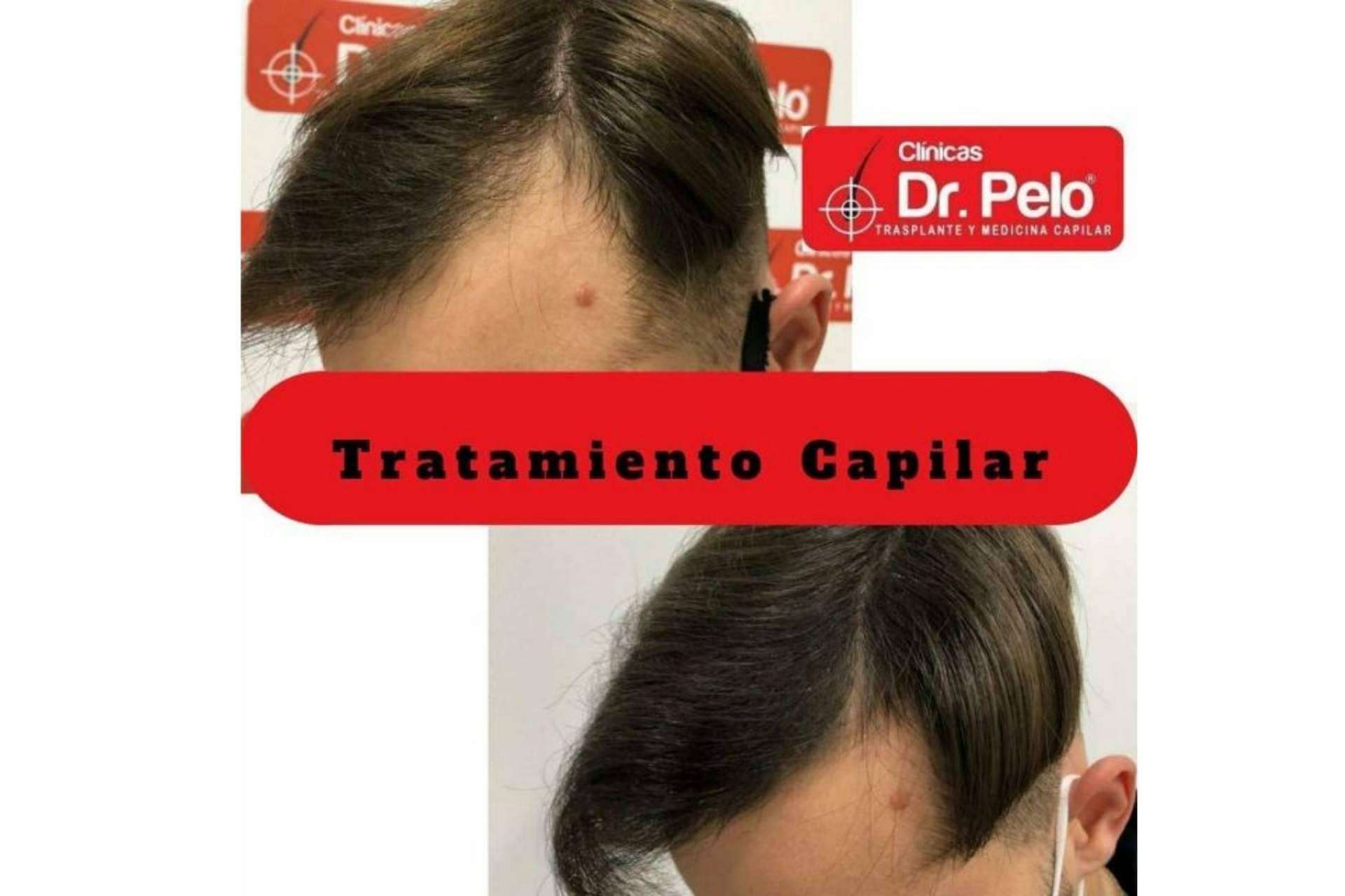 Mejores resultados de trasplante capilar en España con Clínica Dr. Pelo