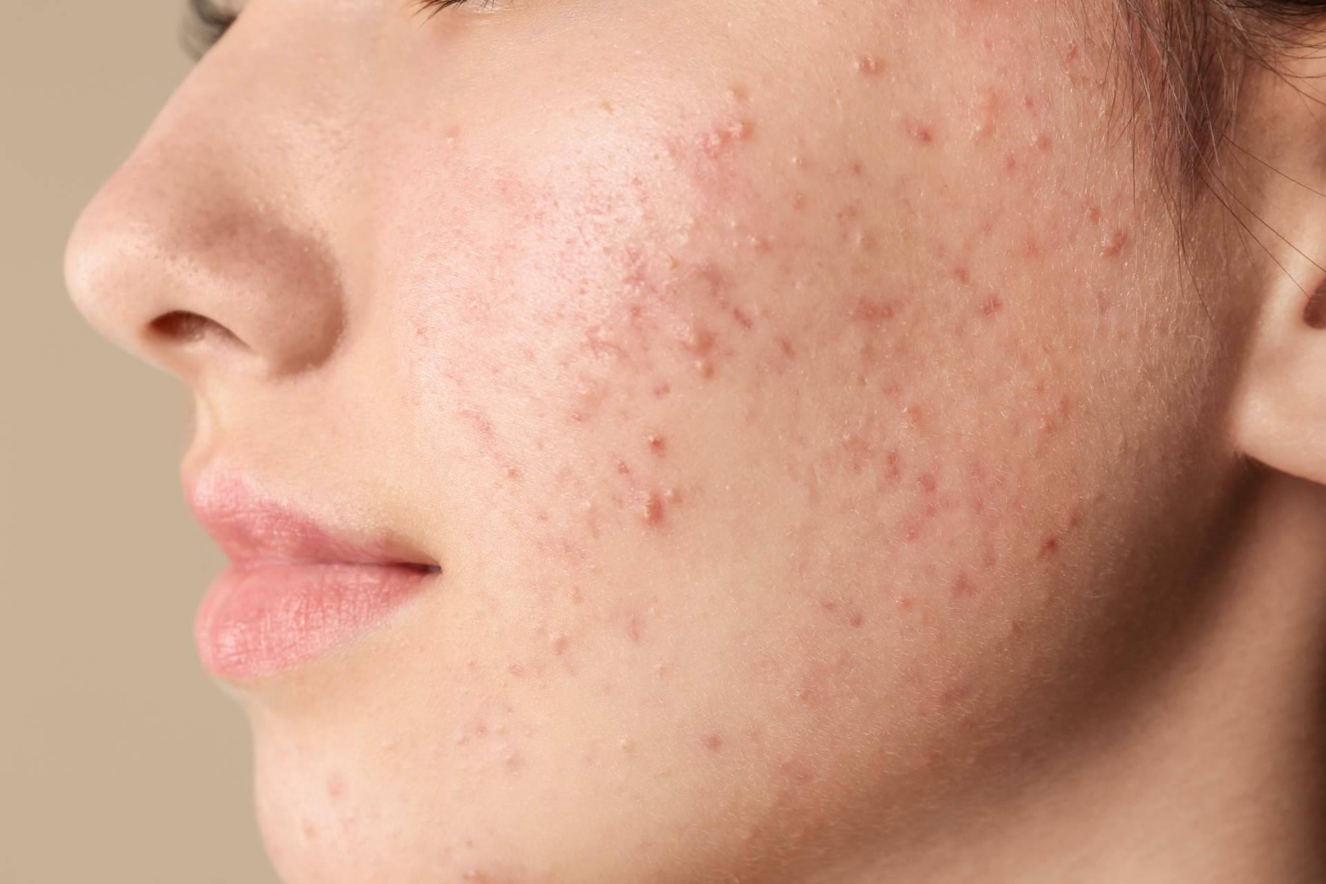 Terminar con las espinillas y el acné es posible actualmente gracias a AcnéXero, una aplicación de inteligencia artificial fundada por dos dermatólogos