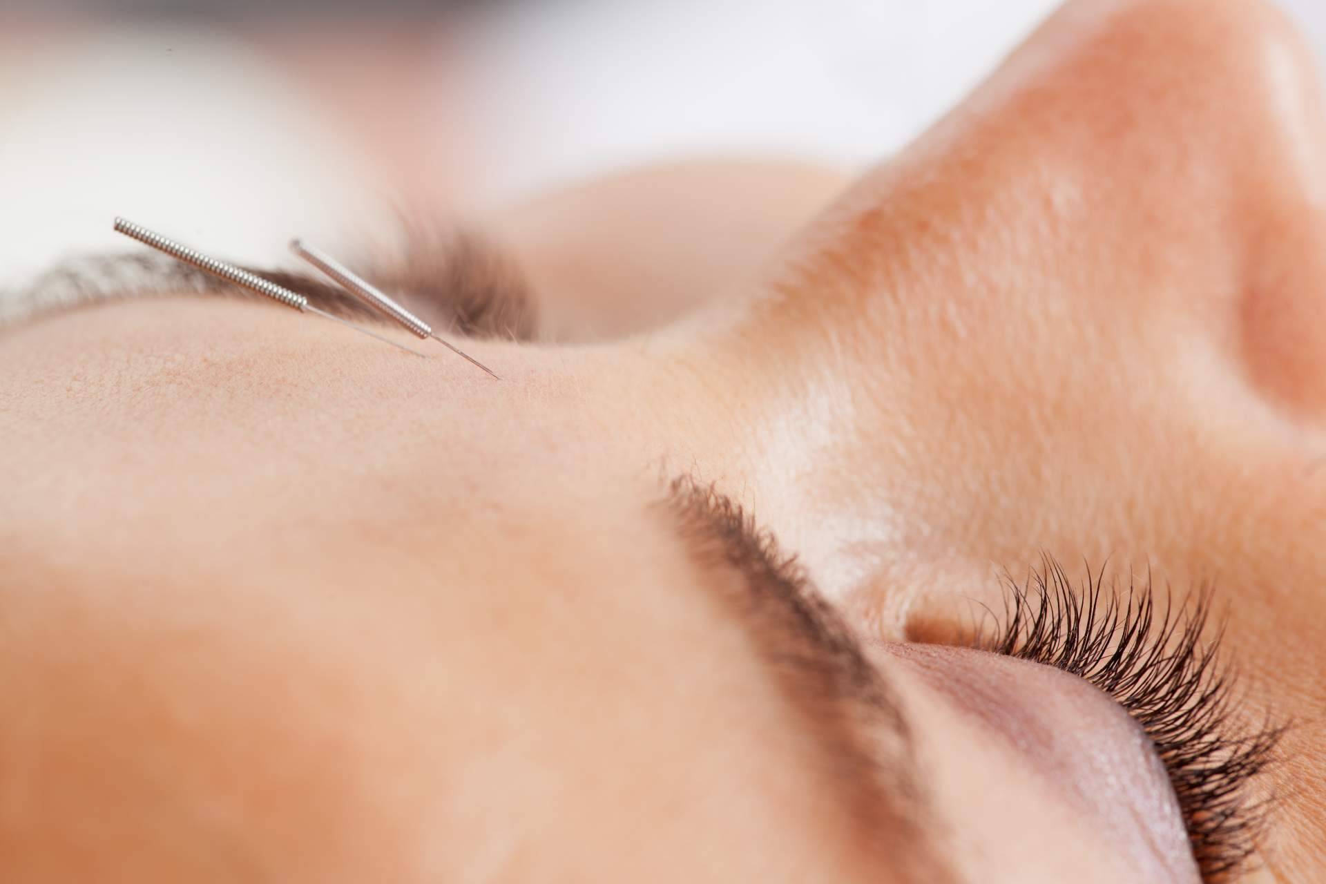 Acupuntura estética a domicilio por el centro Kikai
