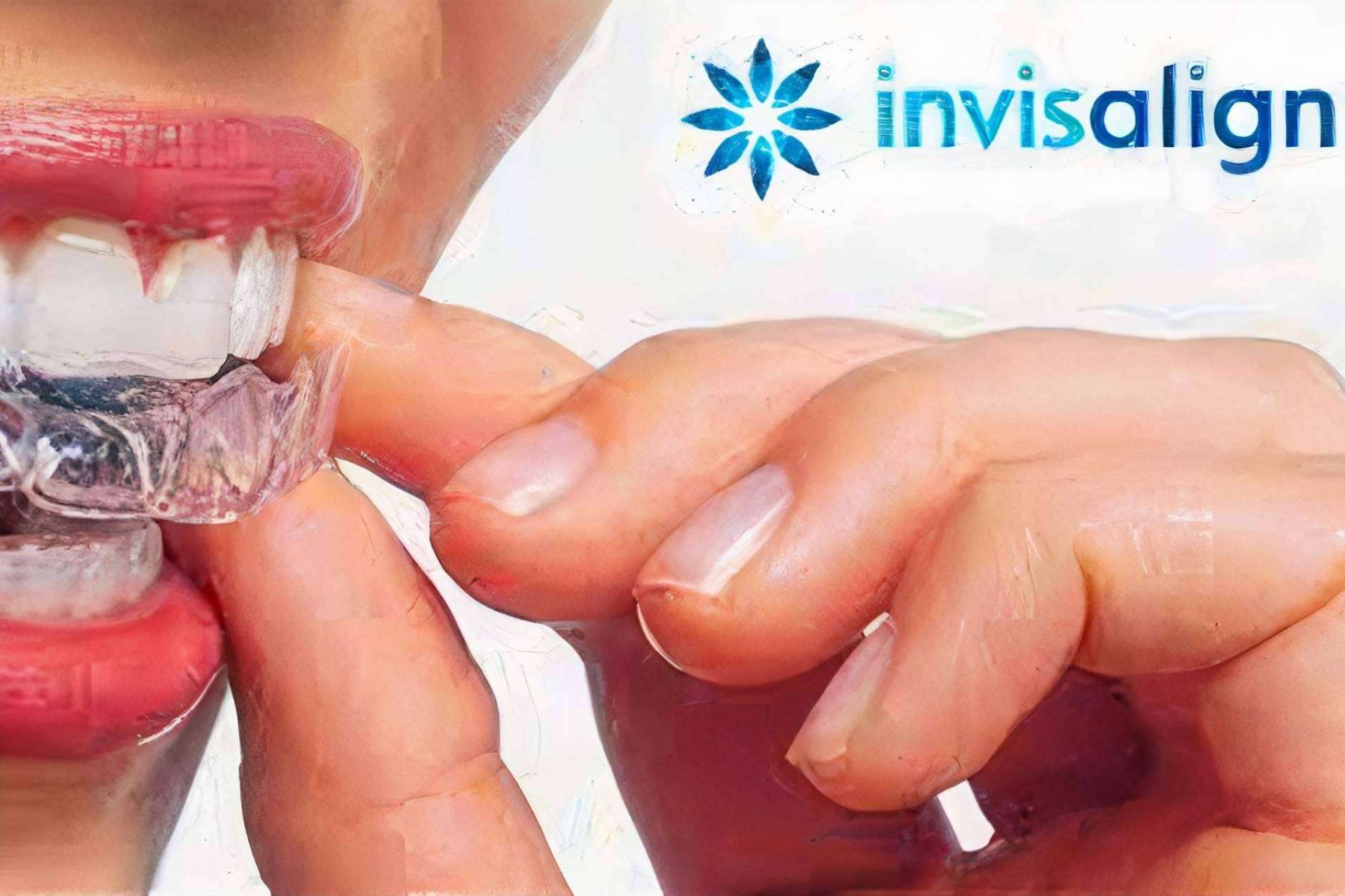 La técnica Invisaling en Valencia: ¿Por qué es cada vez más popular?