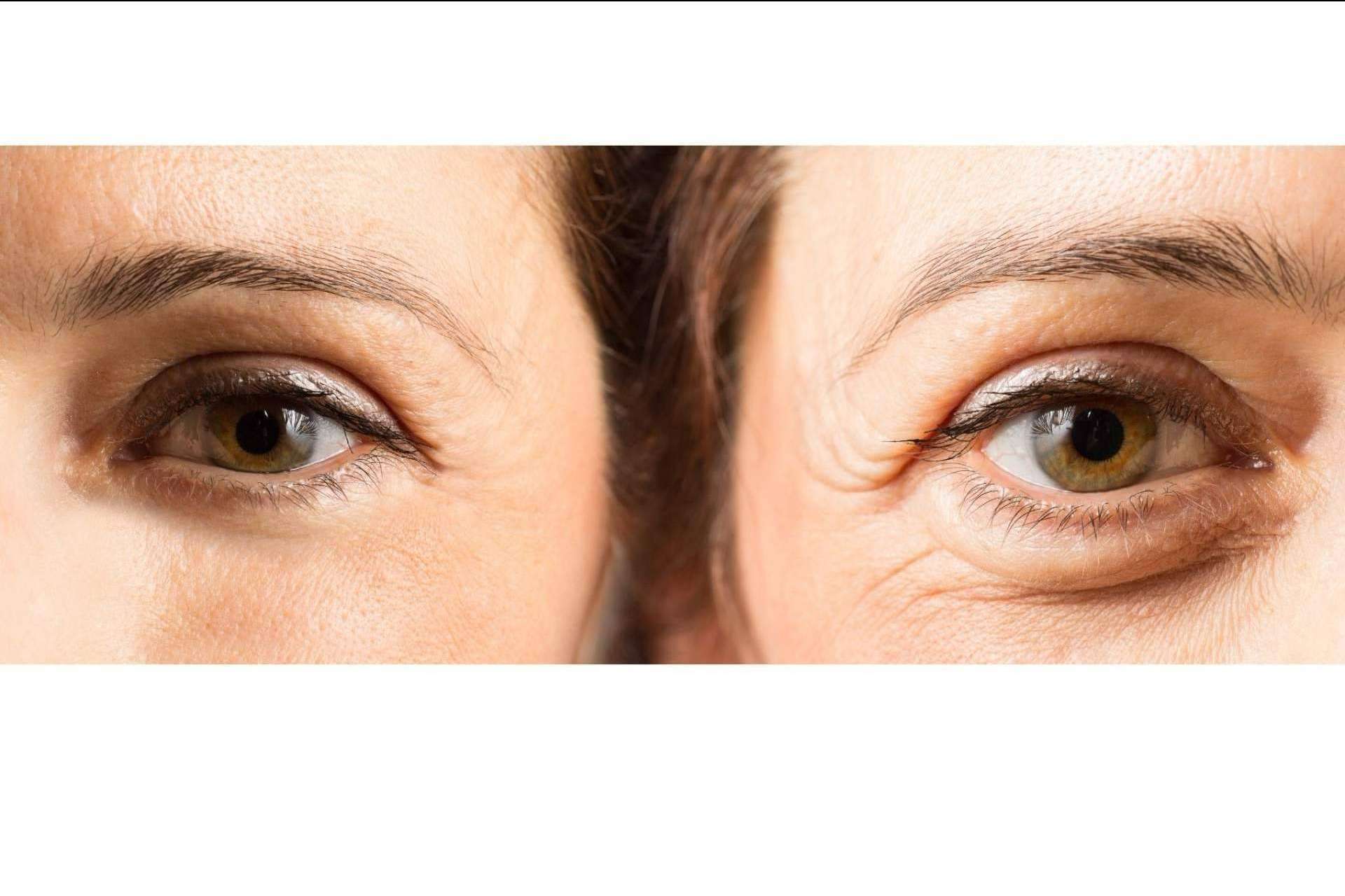 Dra. Alfonsina Uriburu: el ácido hialurónico para combatir las ojeras en la Unidad de medicina estética FEMME de Santiago de Compostela