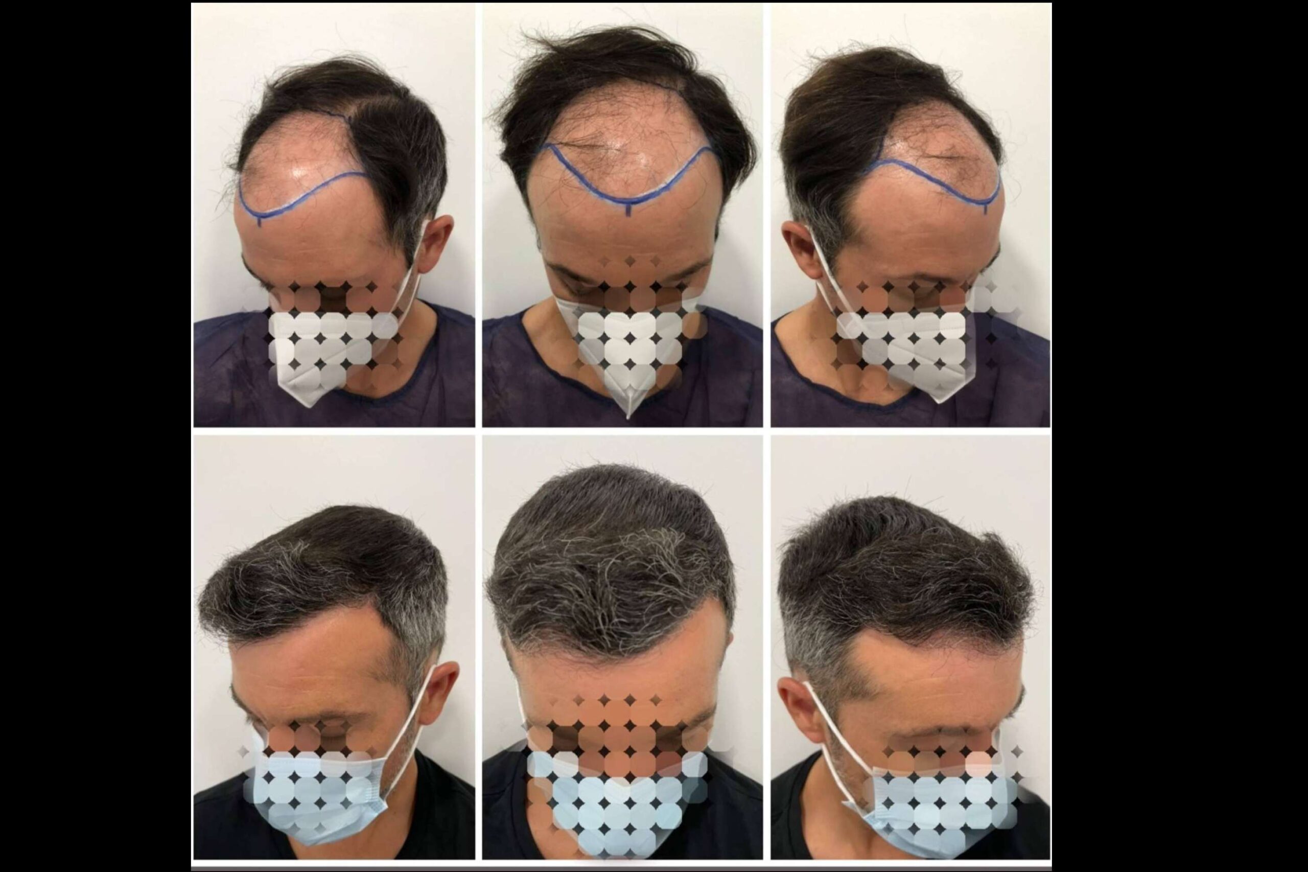 El injerto o trasplante capilar entre las técnicas más recomendadas por el especializado Dr Bruno Jacobovski