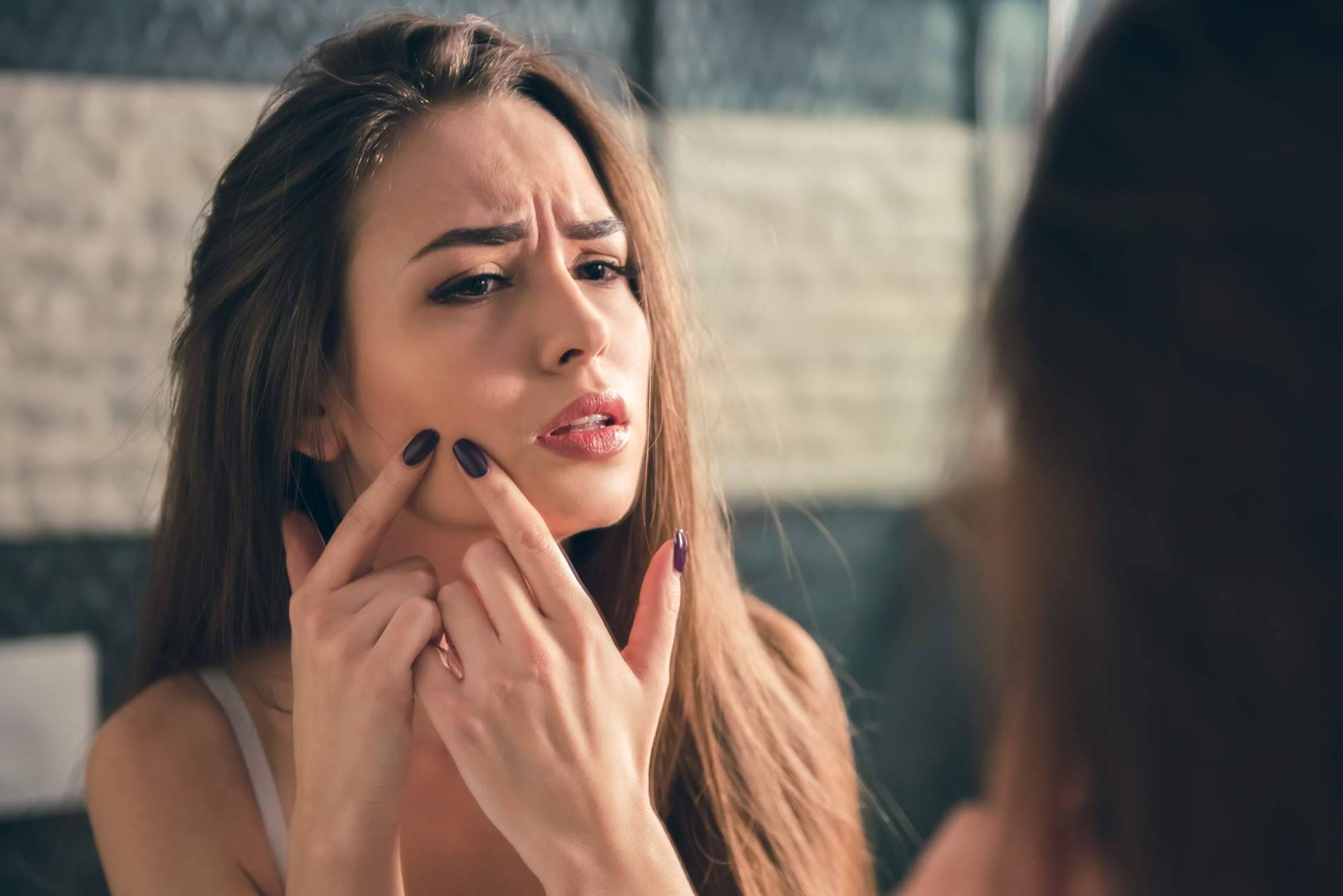 Acné Xero permite quitar espinillas y granos