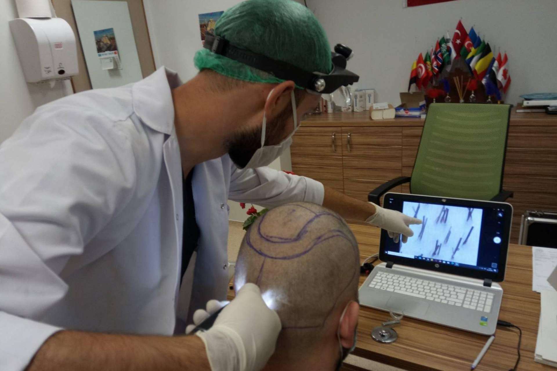 FUE Hair Transplant System: injerto capilar Turquía todo incluido
