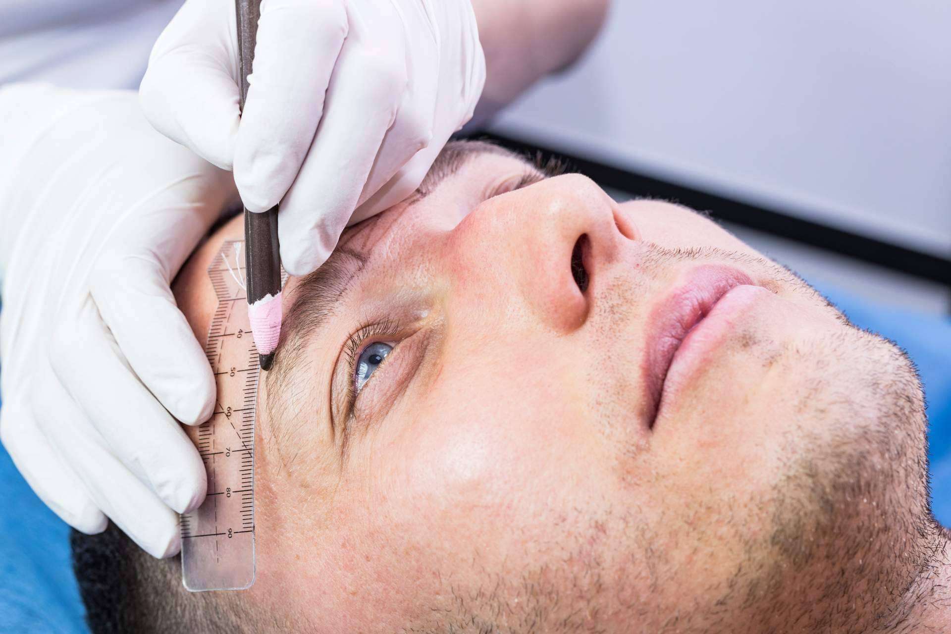 El procedimiento de trasplante capilar en las cejas realizado por Clínicas Dr. Pelo