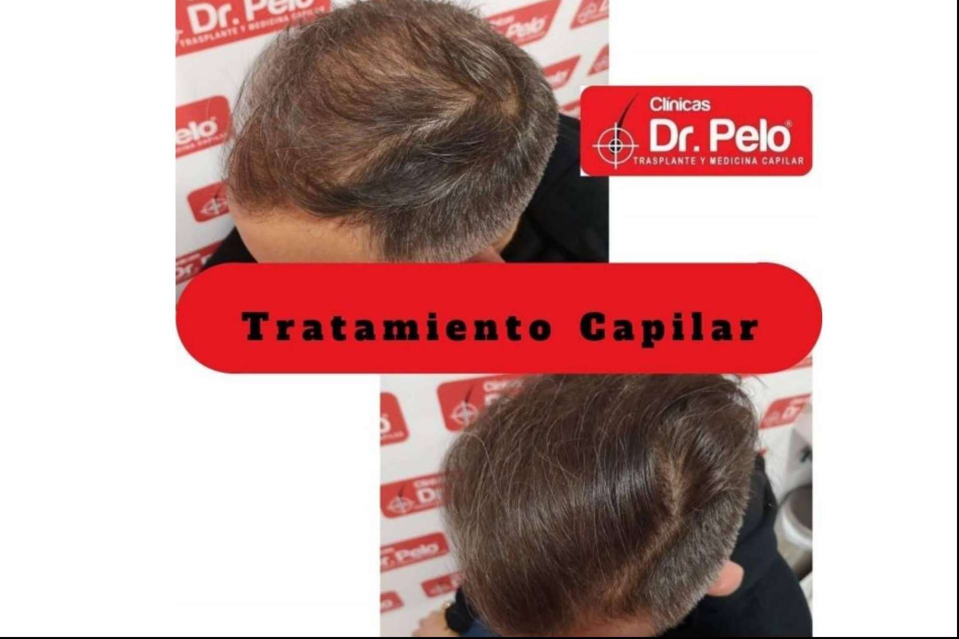 Las ventajas del láser capilar LedHair de Dr. Pelo