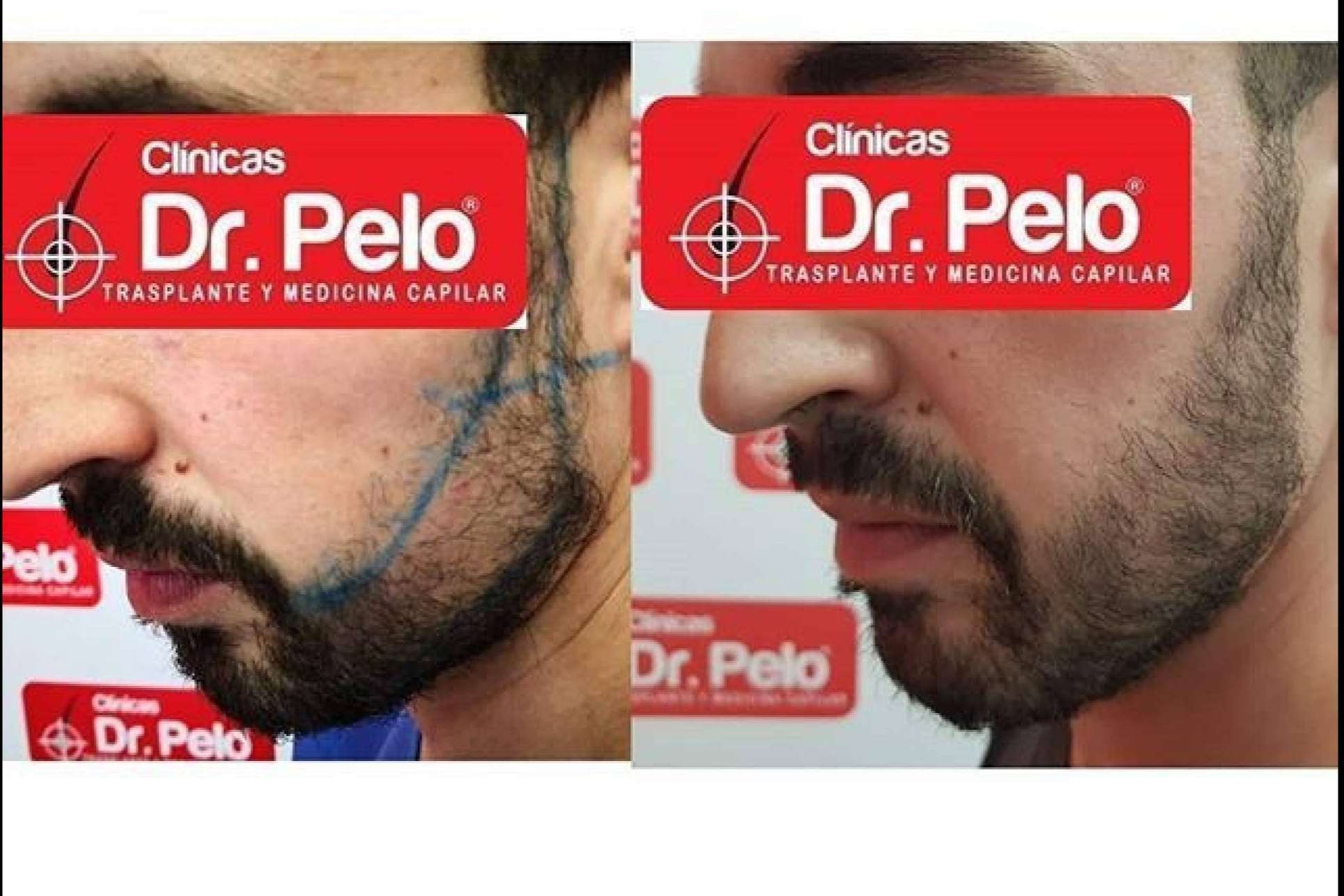 Clínicas Dr. Pelo: el trasplante de barba, uno de los tratamientos con mejores resultados