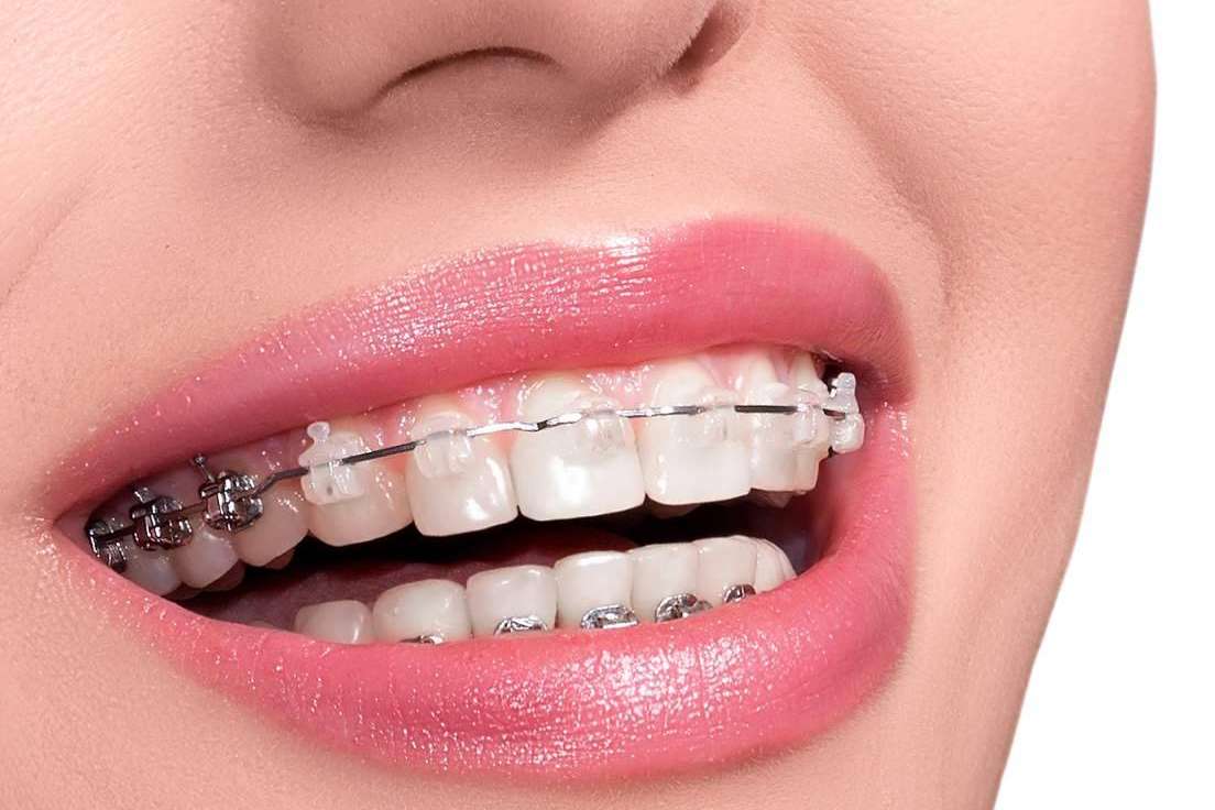 Helident Clínica Dental ofrece tratamiento de ortodoncia con brackets