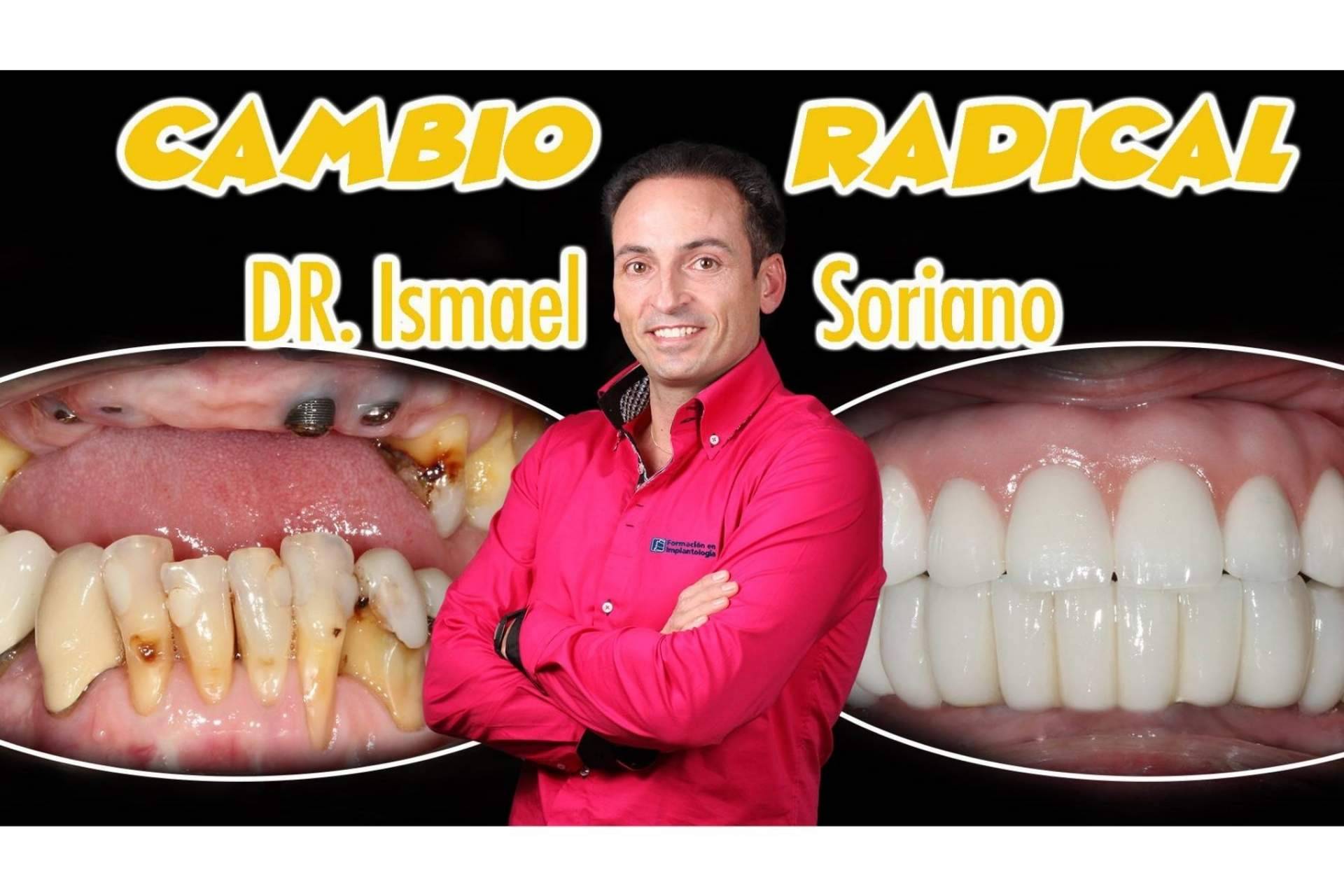 La técnica de implantes con dientes inmediatos del Dr. Ismael Soriano ofrece numerosas ventajas a los pacientes