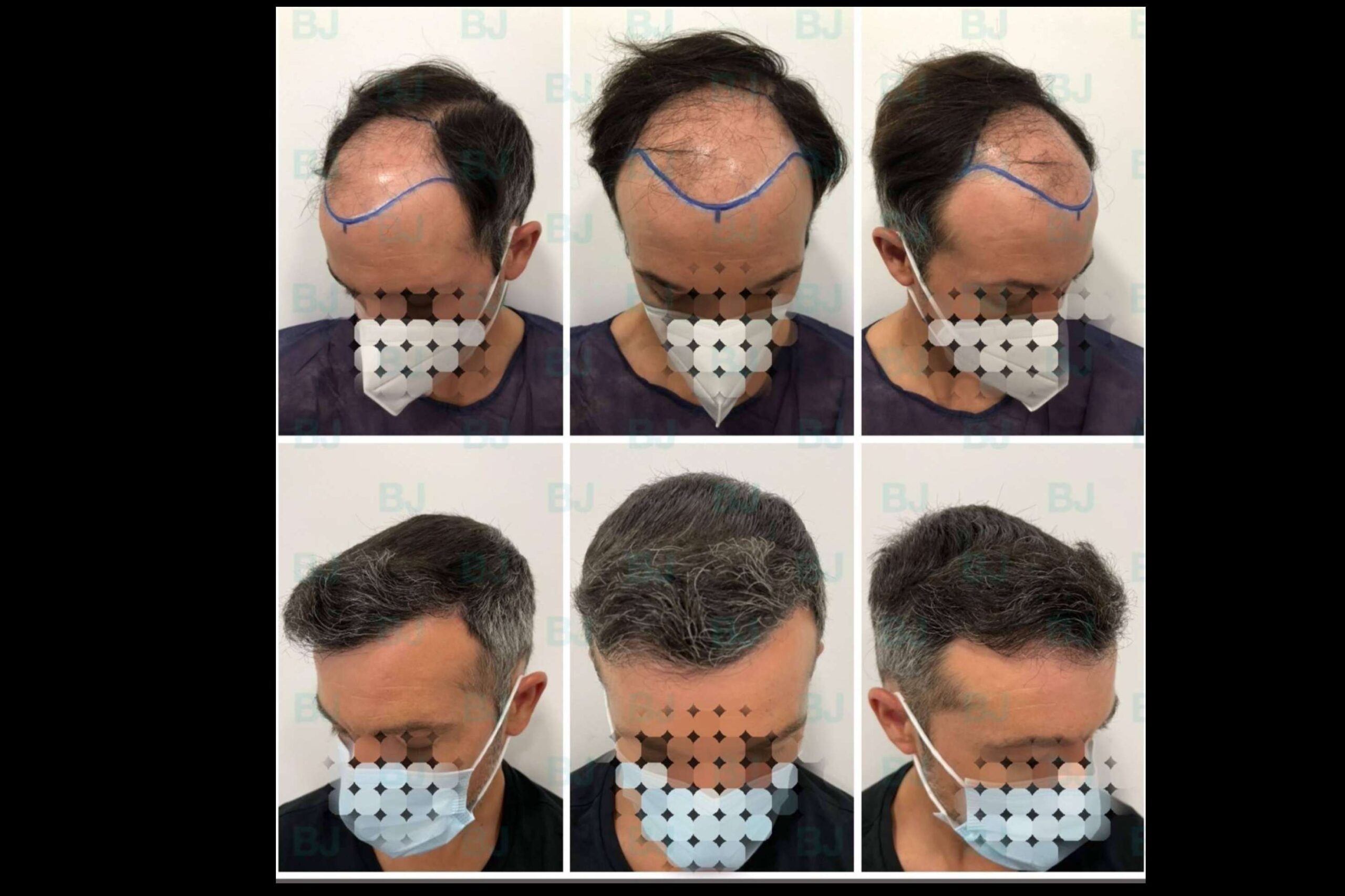 Dr. Bruno Jacobovski, especialista en injerto capilar en Barcelona con más de 500 intervenciones de éxito
