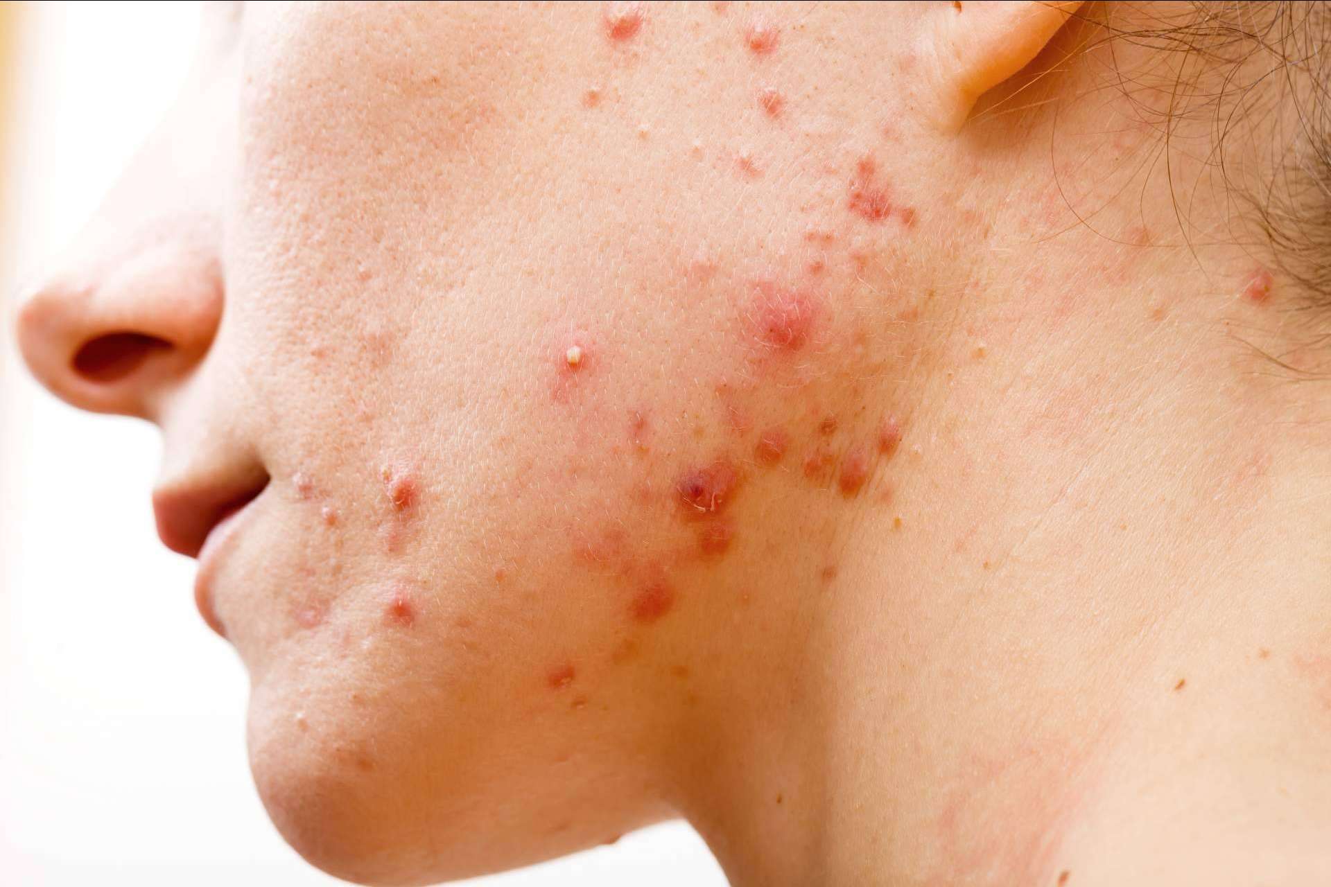 AcnéXero, la aplicación ideada por dermatólogos que propone soluciones efectivas contra el acné