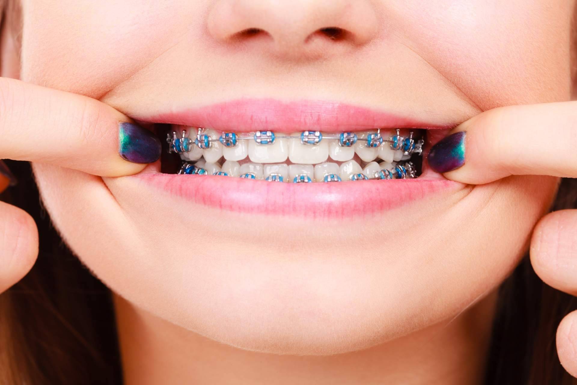 La Clínica Sonrisas de Corrales Dental realiza tratamientos con ortodoncia de máxima calidad en Badajoz, gracias a sus expertos