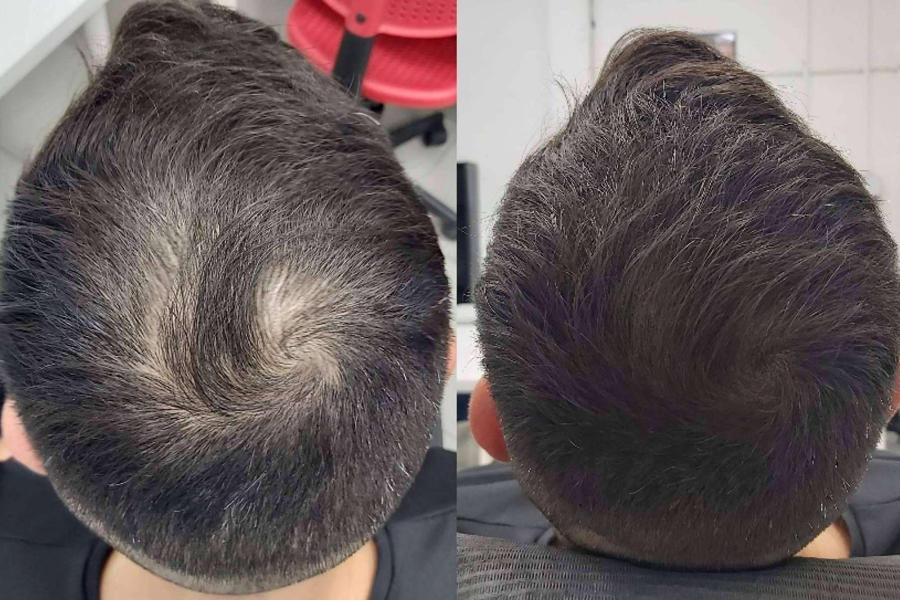 Las Clínicas Dr. Pelo realizan tratamientos de micropigmentación con efecto de redensificación