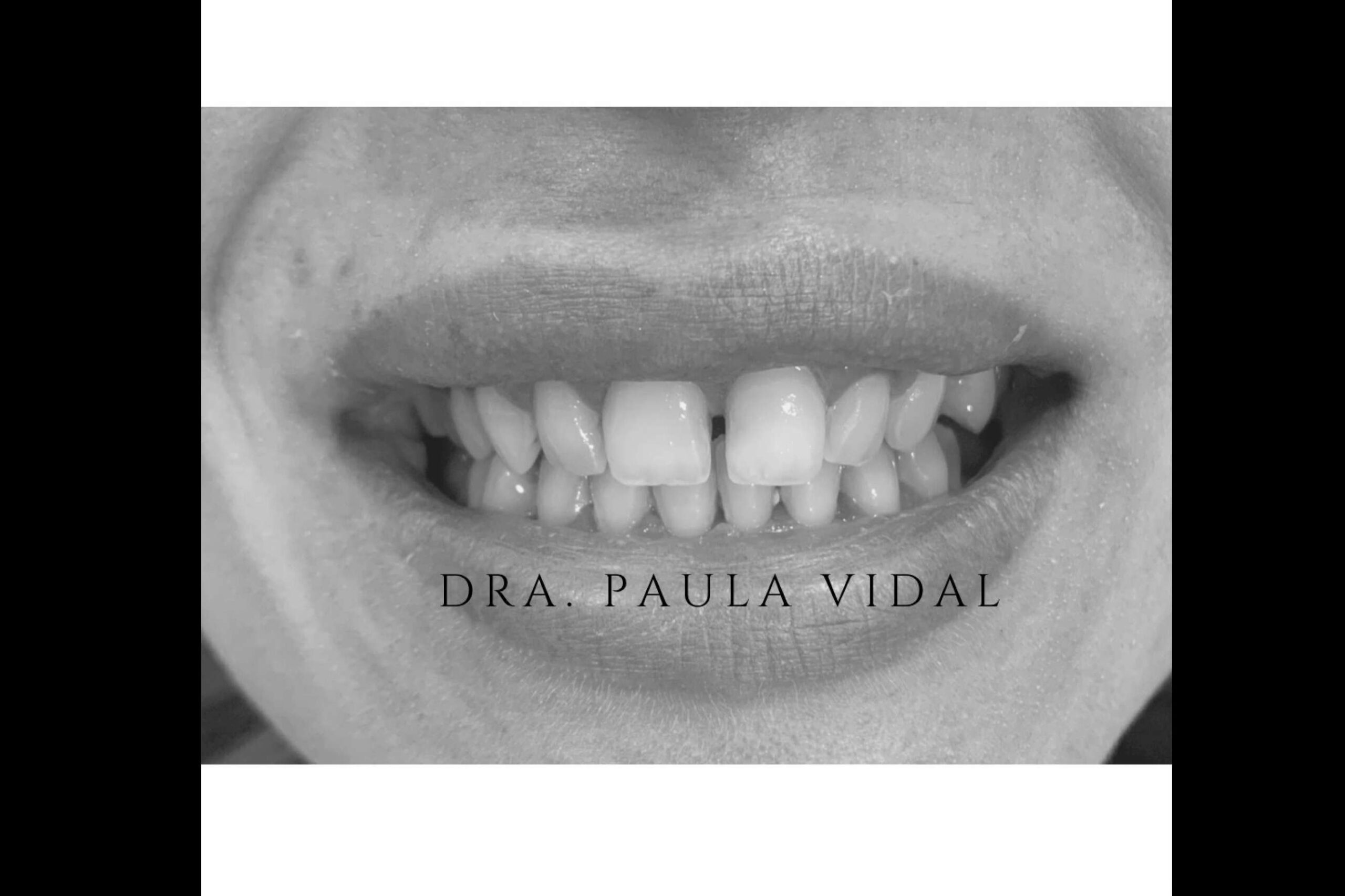 Clínica Paula Vidal, carillas dentales de calidad