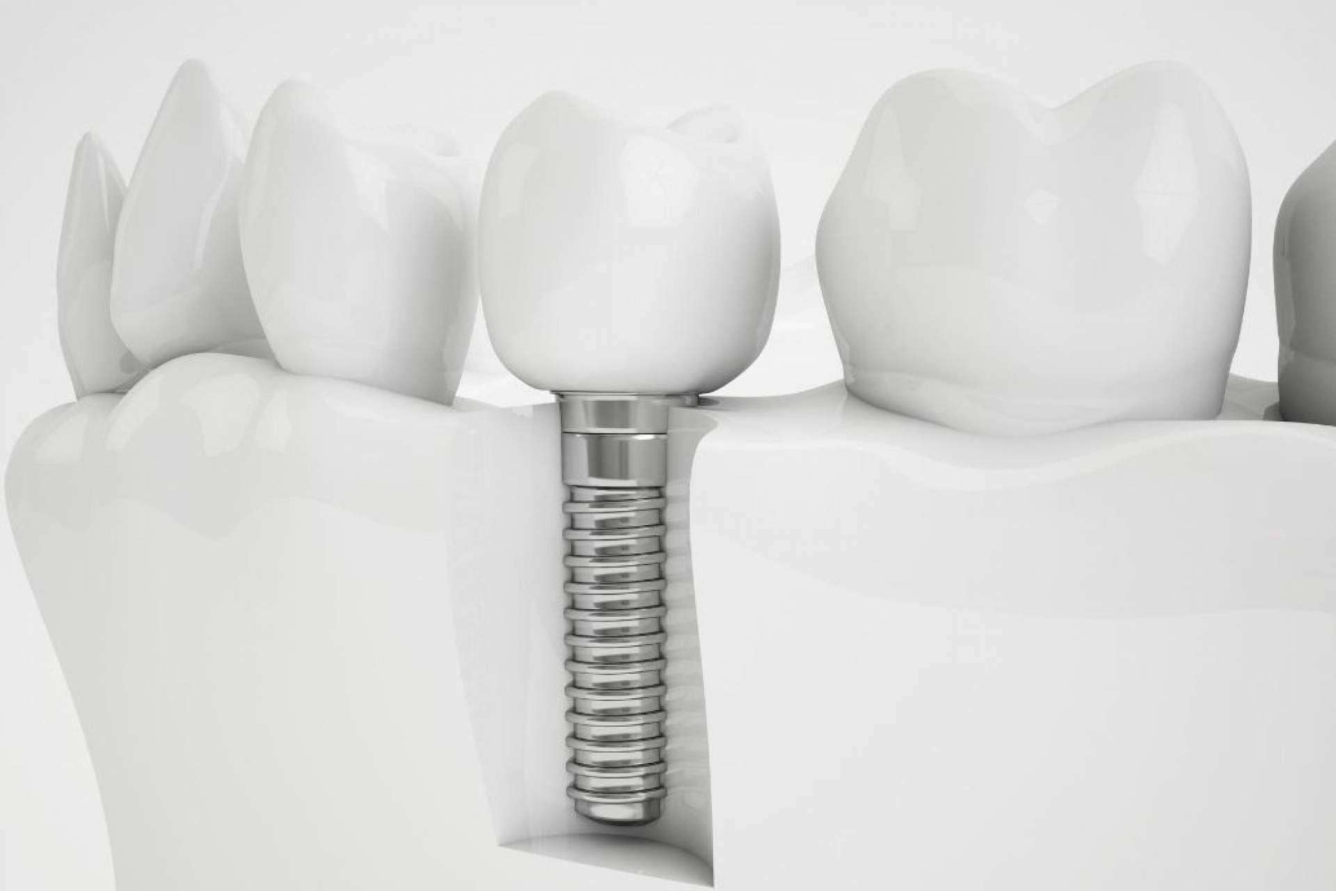 Grupo Gente Vital ofrece implantes dentales