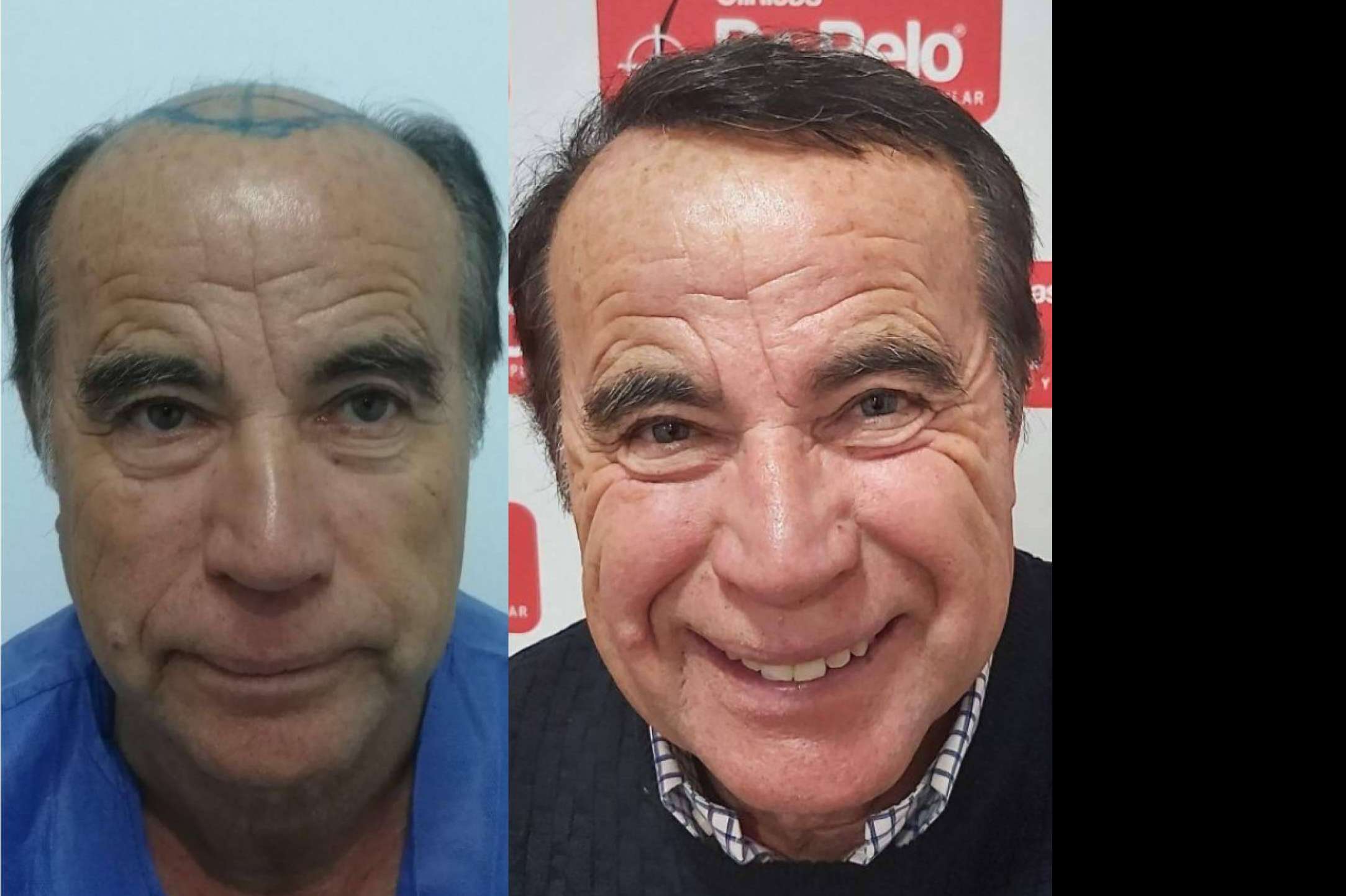 Conseguir trasplantes capilares con efecto natural de la mano de Clínicas Dr. Pelo