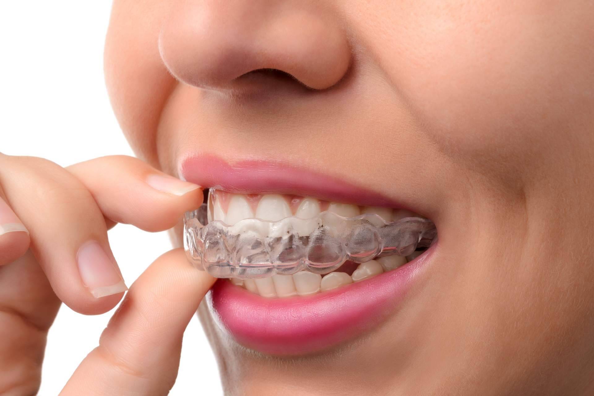 Invisalign con DeltaDent