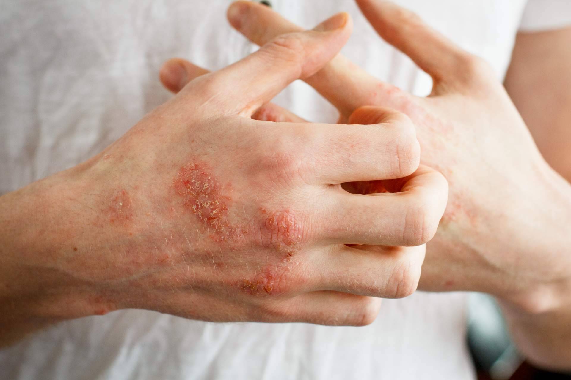 ¿Eczema de contacto o eczema atópico?, por Laboratorio Géomer
