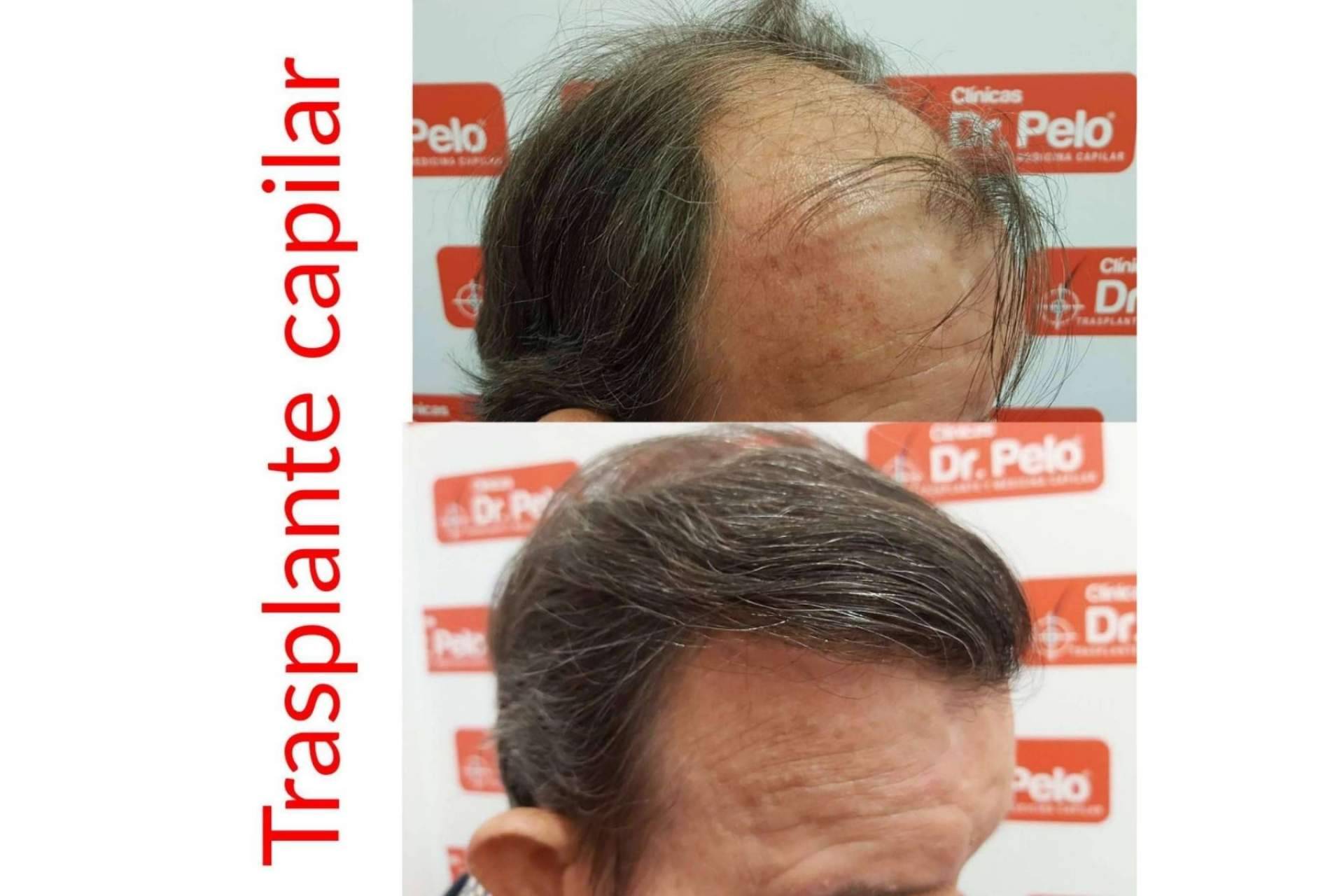 Dr. Afonso Junior realiza la Técnica Progresiva Capilar con una primera cita online gratuita