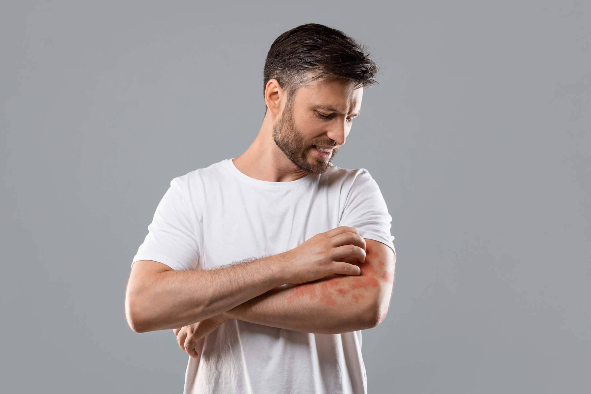Tratamiento efectivo para la psoriasis con la línea de productos Soriasel