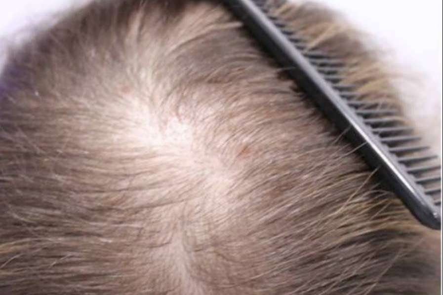 Tipos de alopecia femenina y métodos para combatirla según la clínica Injermur