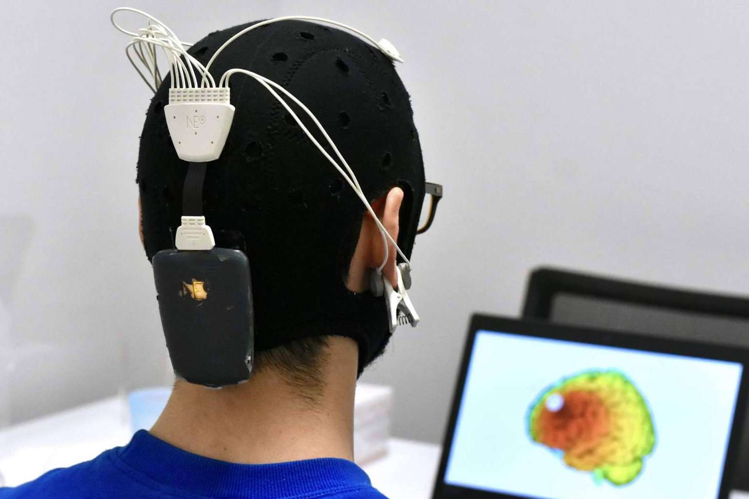 Los tratamientos de neuromodulación aceleran la recuperación tras sufrir un ictus