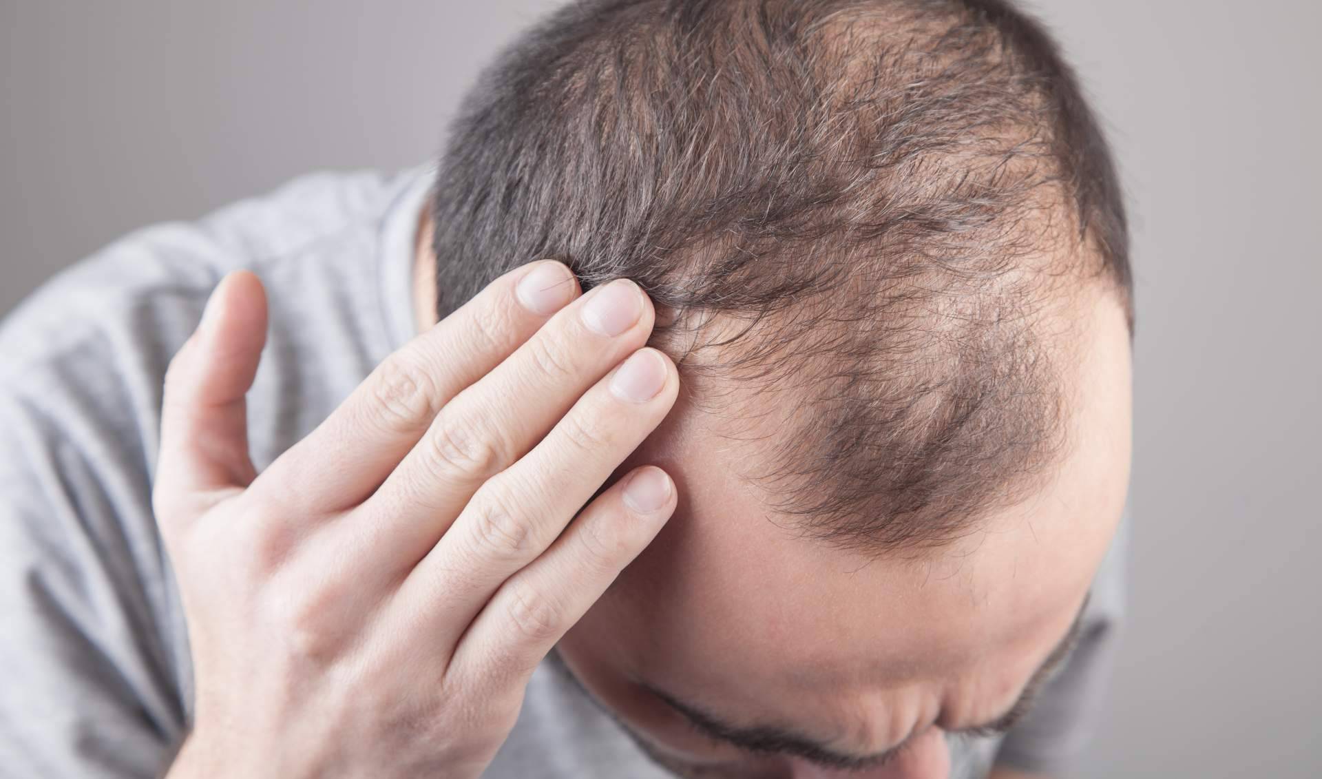 Combatir la alopecia con injertos capilares efectivos de la mano de Élite Capilar