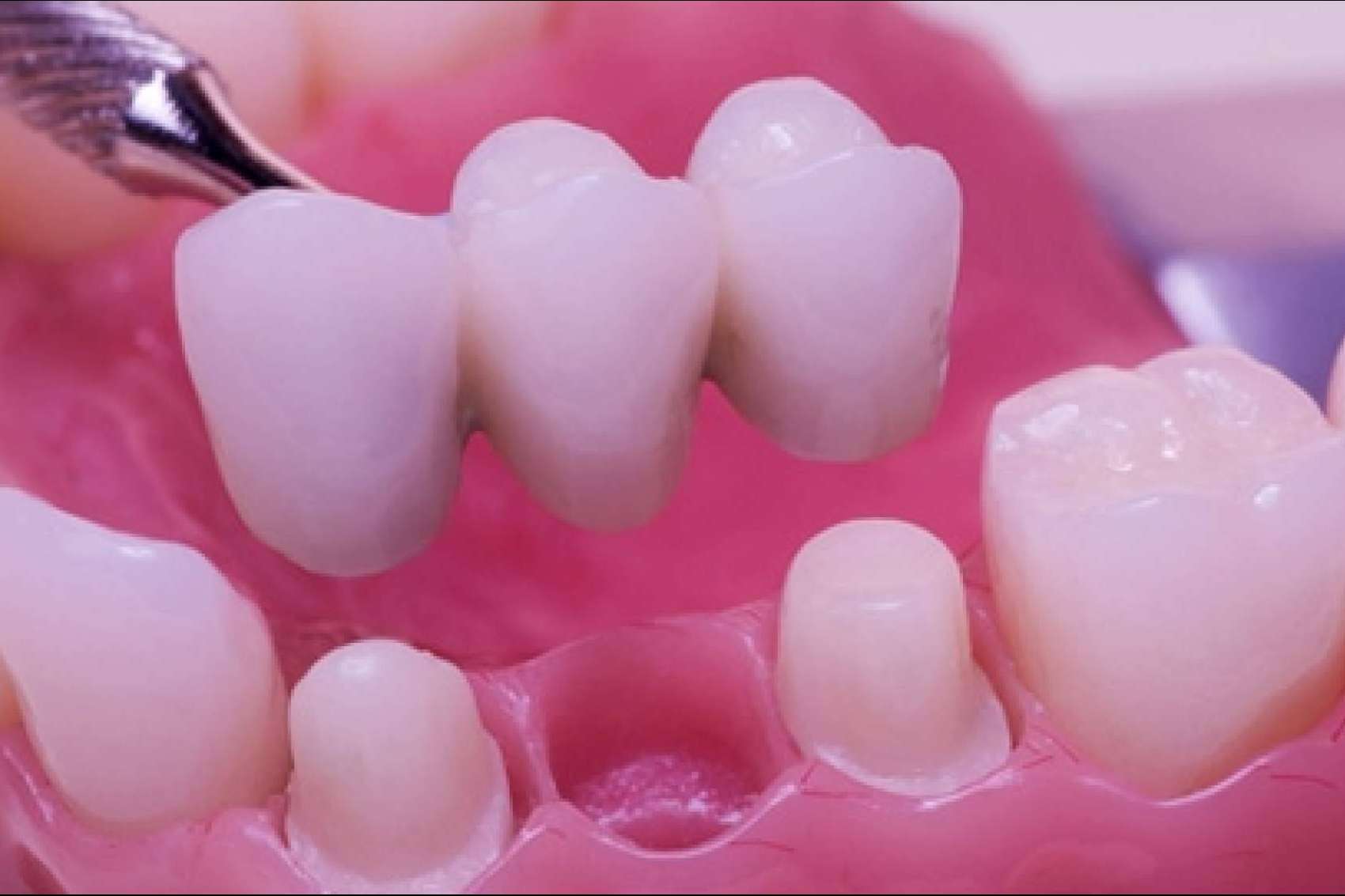 Dental Implantologie ofrece laboratorio propio para el servicio de estética dental y ortodoncia invisible