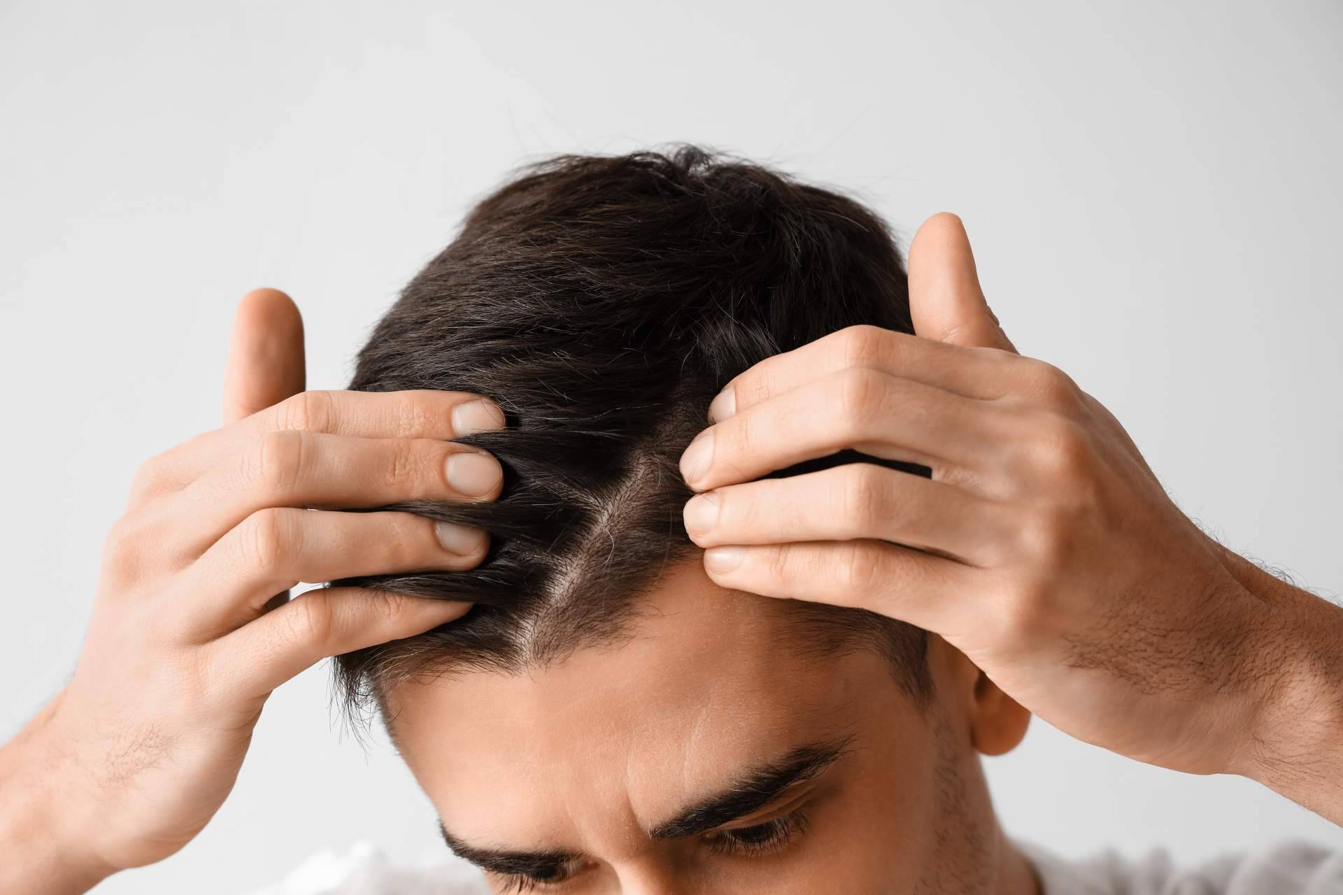 La Clínica Estética SILOE es especialista en llevar a cabo el tratamiento de injerto capilar Valladolid