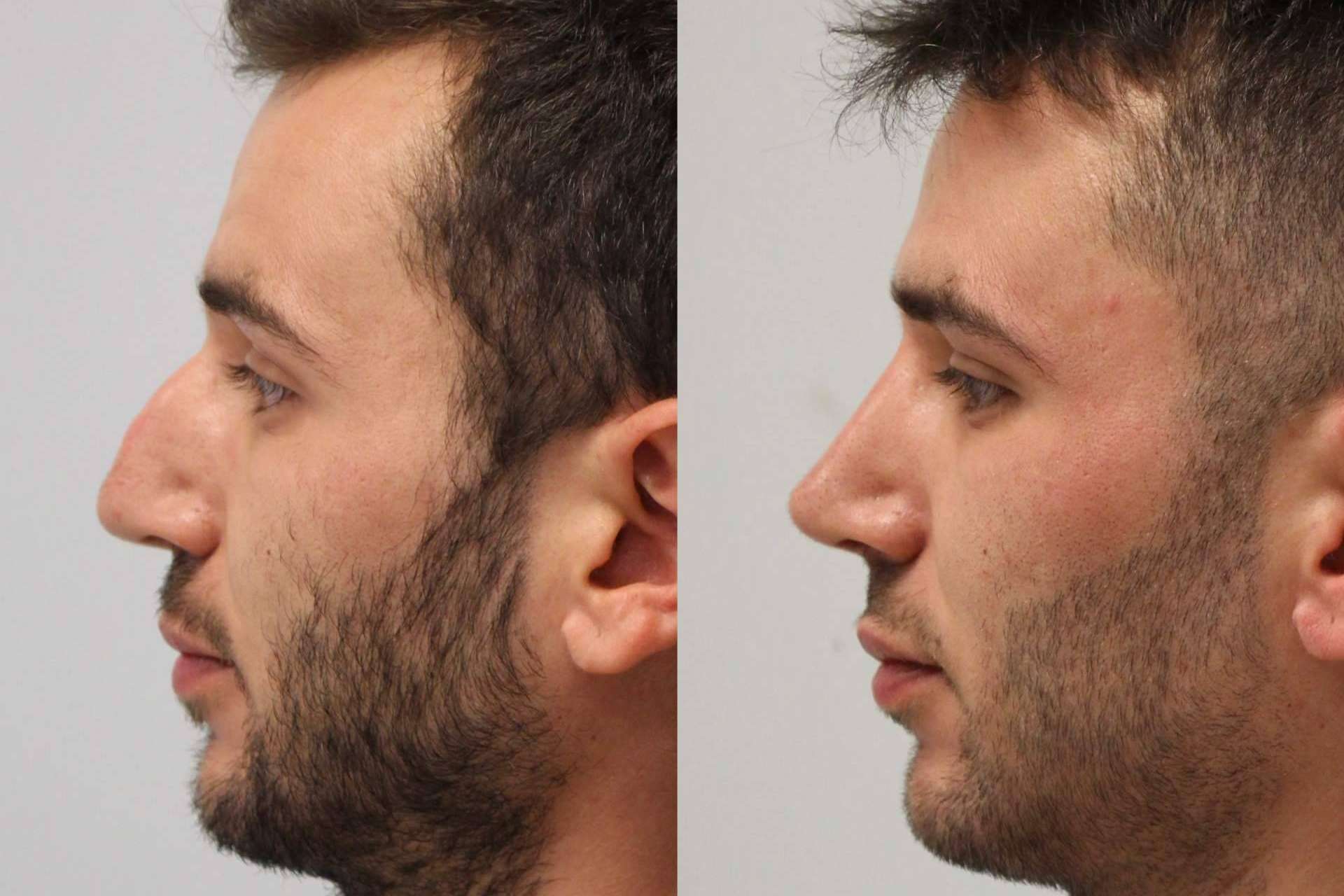 En Valladolid y Santander está disponible el avance médico de la rinoplastia ultrasónica