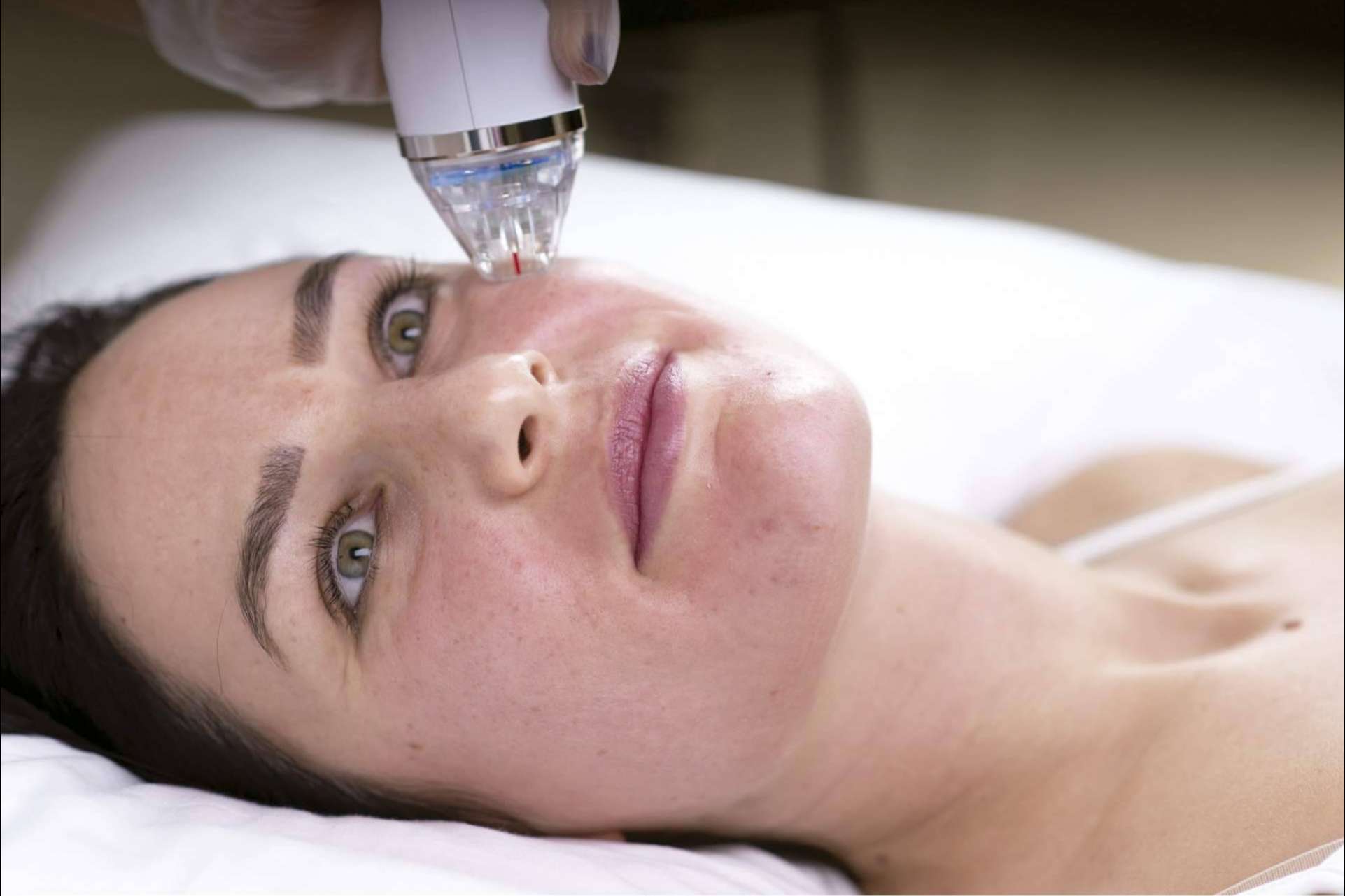 El tratamiento de radiofrecuencia fragmentada con microagujas de Alluring Clinic