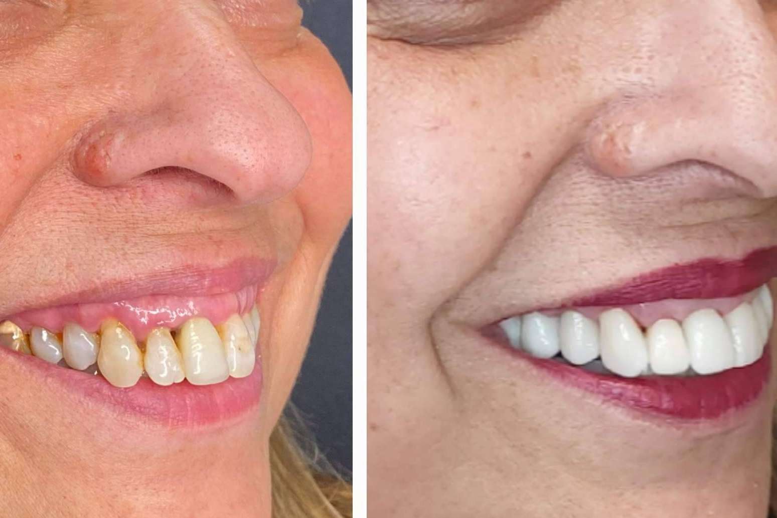 Todo lo que hay que saber sobre las carillas dentales, por la clínica Dentinova