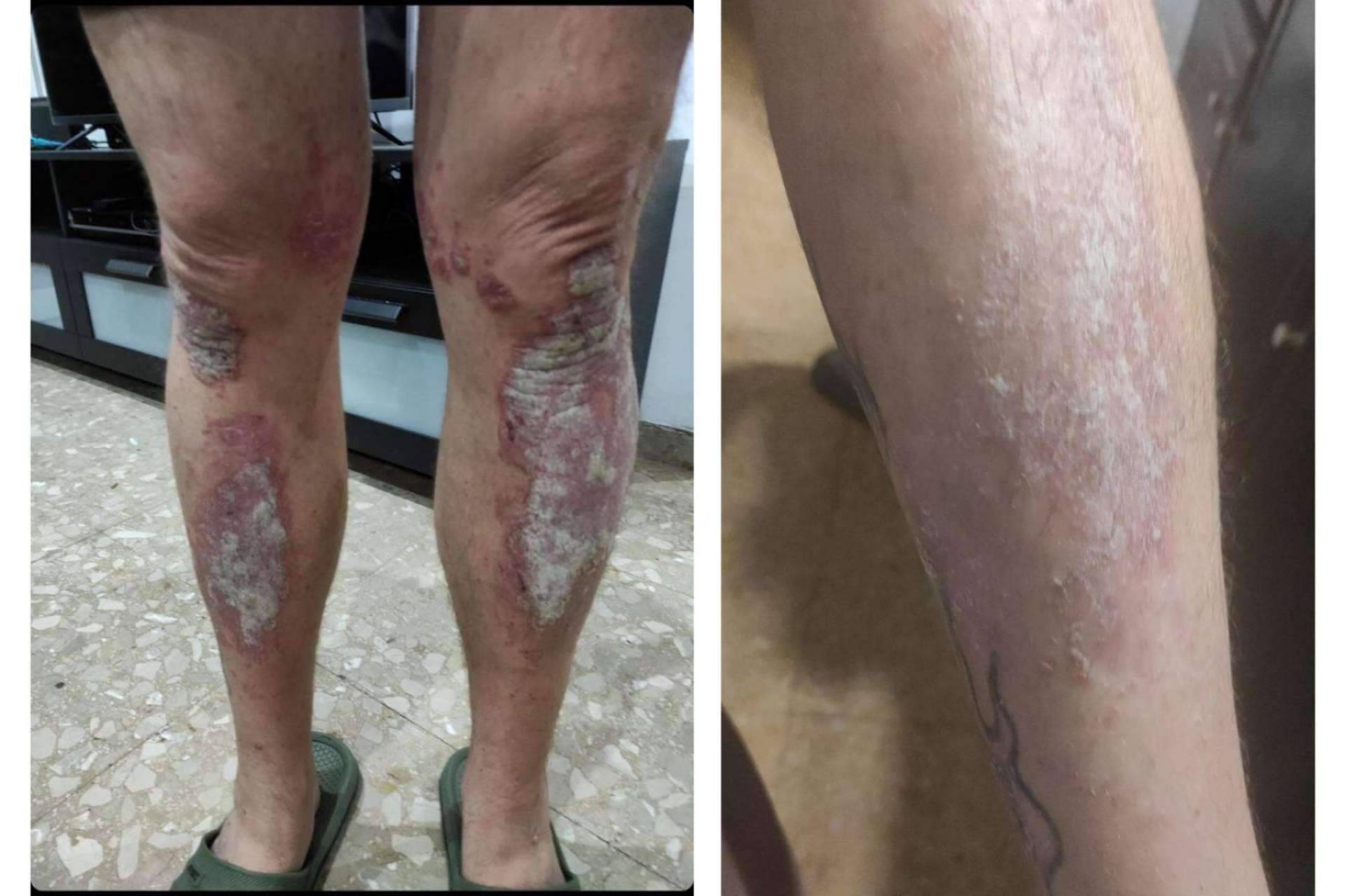 El antes y después de usar la crema hidratante en pieles atópicas de Green Cornerss