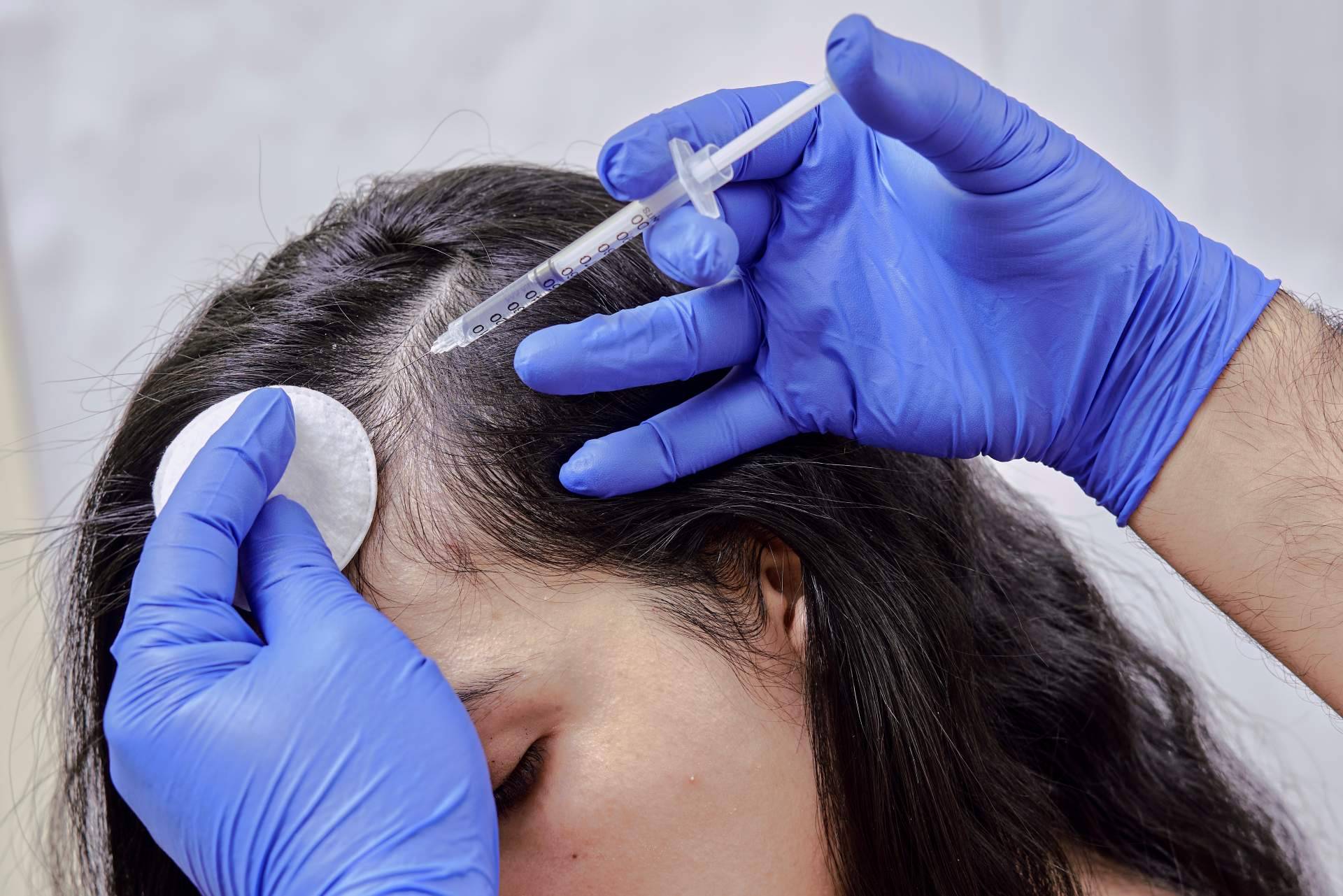 ¿En qué consiste la mesoterapia capilar, cuáles son sus efectos y su recuperación?, por Élite Capilar