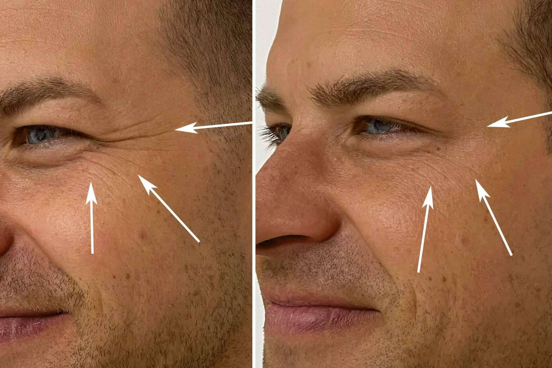El bótox, el tratamiento perfecto para reducir las arrugas de la frente, entrecejo y patas de gallo